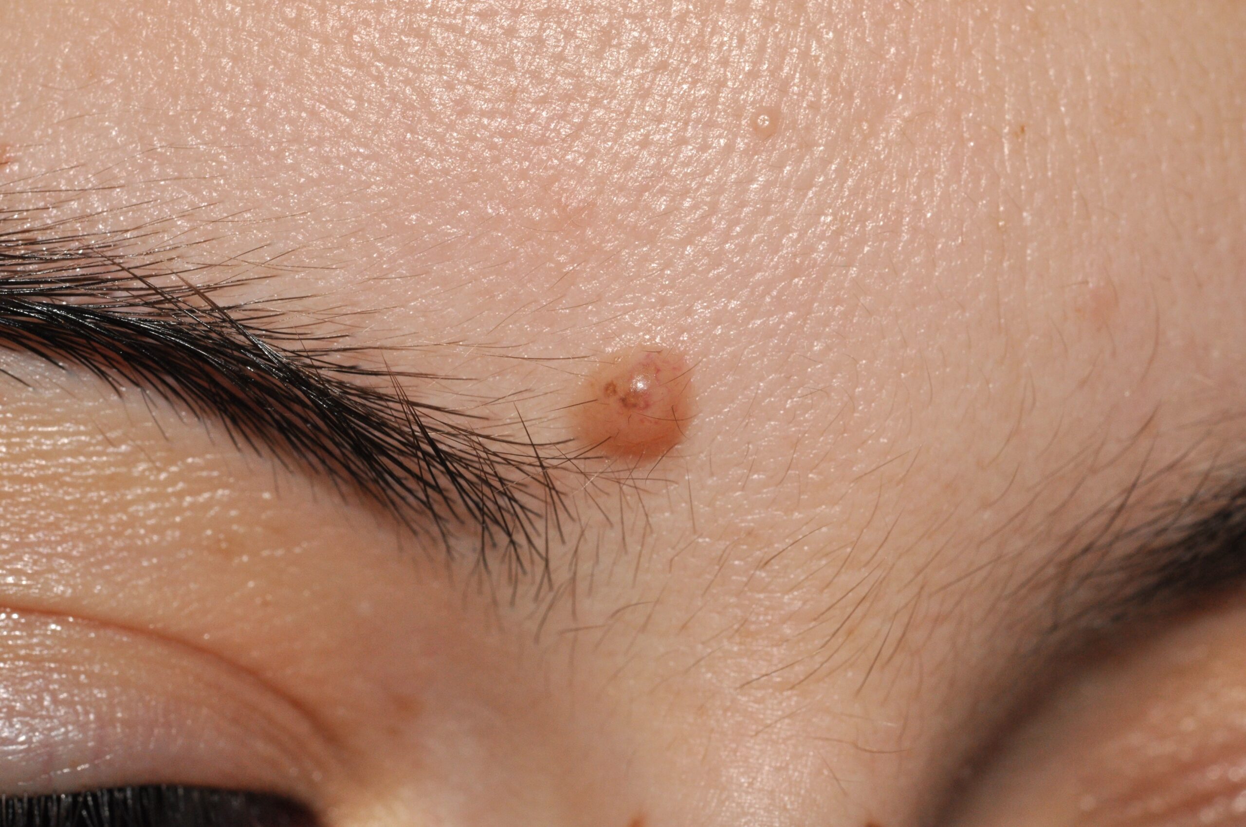 Nevus melanocitico común adquirido intradérmico D22; pápula semiesférica, color piel, con restos de pigmento en su interior