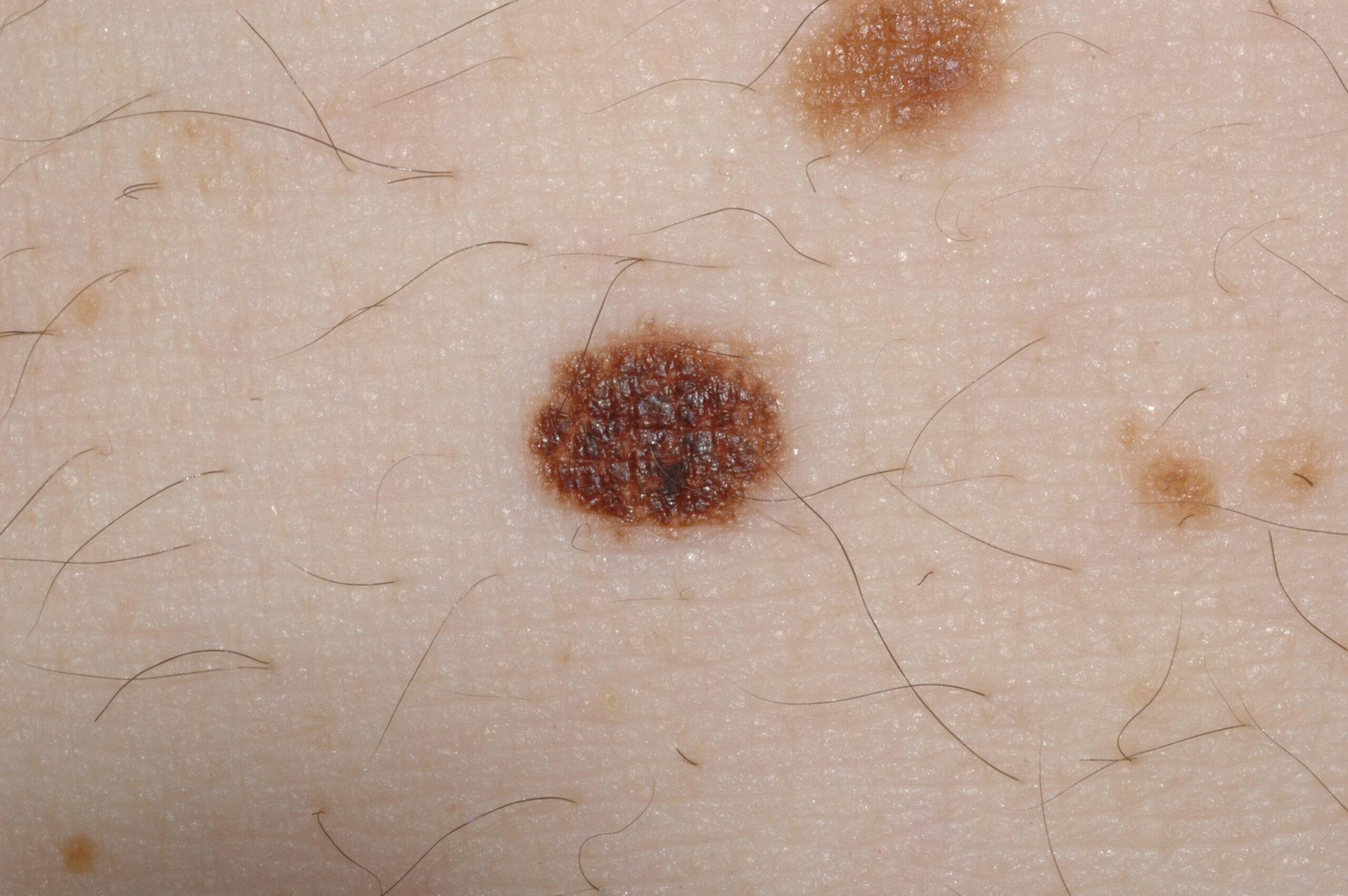 Nevus melanocitico común adquirido juntural D22; mácula pigmentada bicolor, de bordes regulares y de 7 mm en un adulto