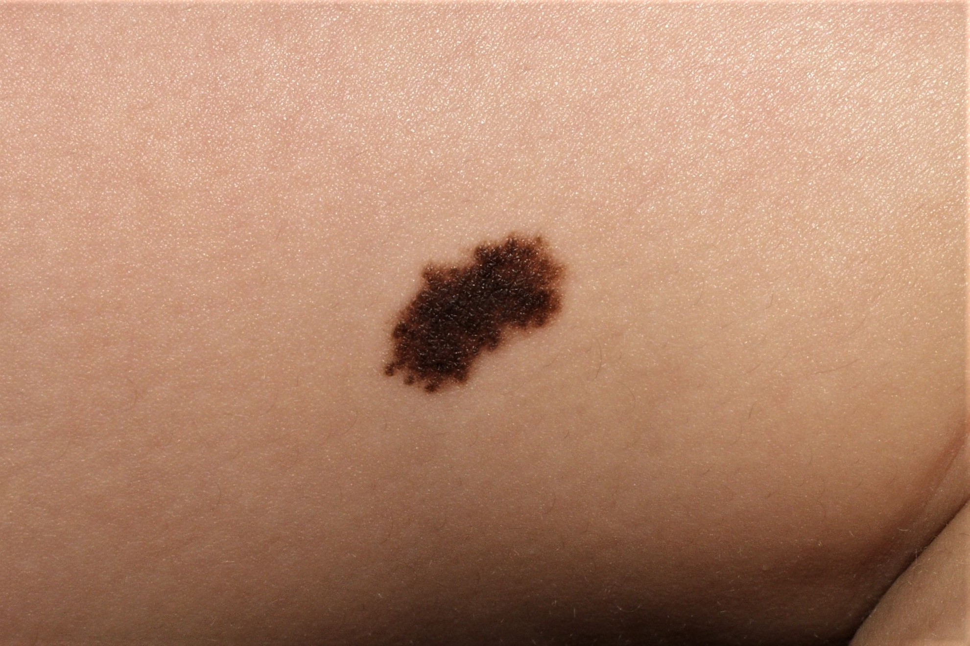 Nevus melanocitico congenito Q82.5 en un niño; máculo-pápula hiperpigmentada, casi negra de borde irregular, de pequeñ tamaño 17 mm, estable