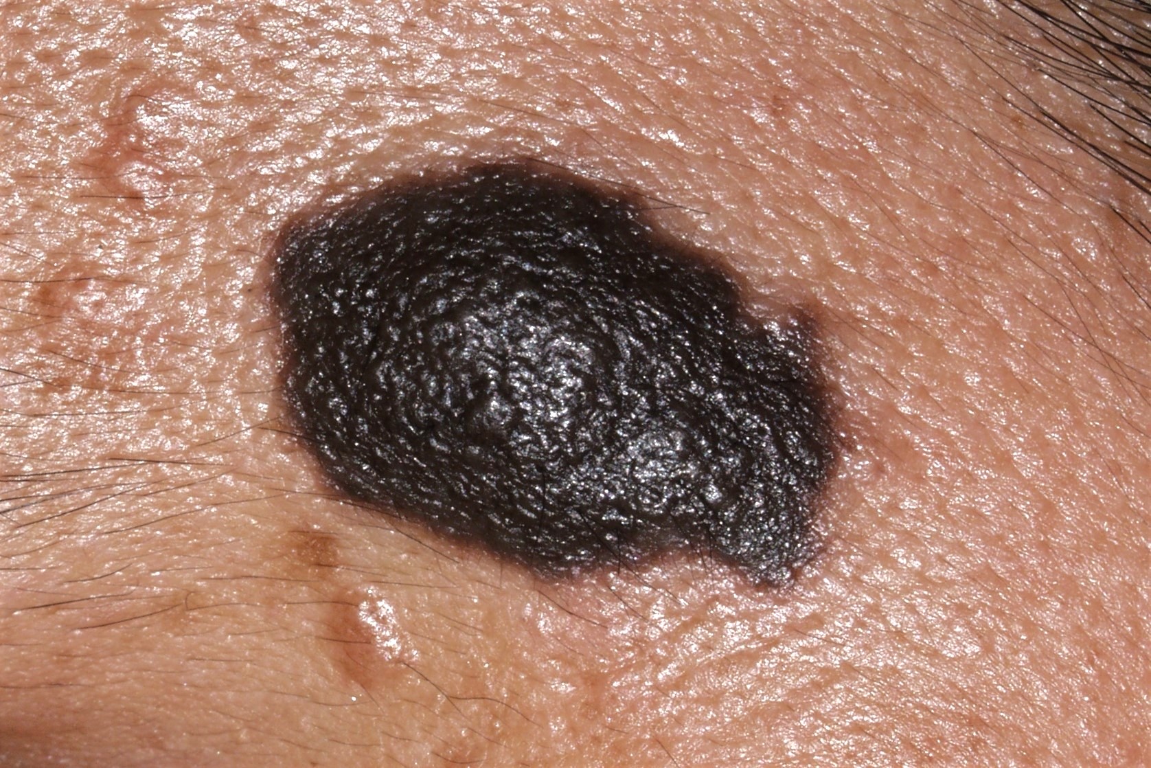 Nevus melanocitico congenito Q82.5; pápulonódulo hiperpigmentado, casi negro de borde irregular, de pequeñ tamaño 19 mm, estable desde hace años (1)