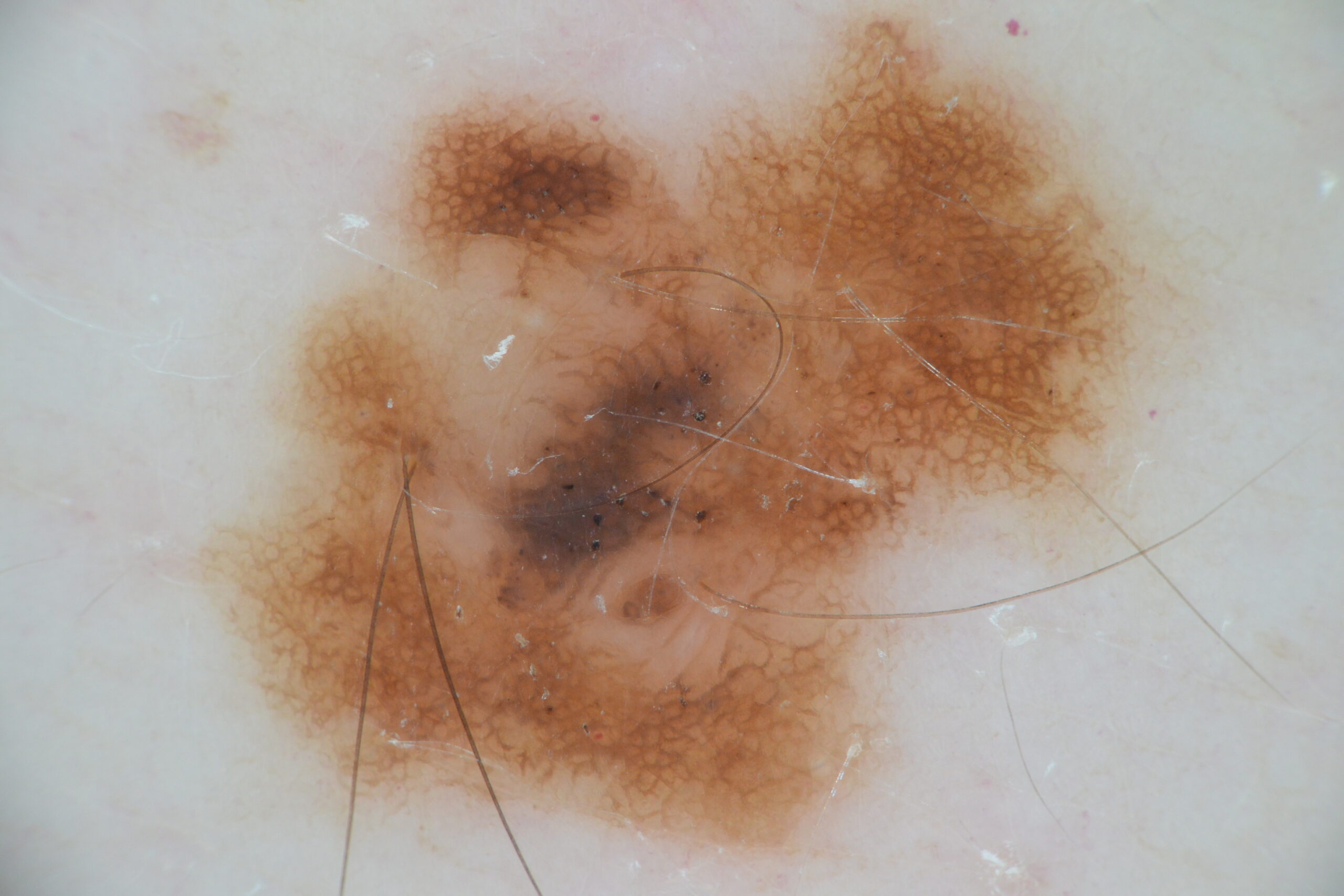 Nevus melanocitico congenito, dermatoscopia. Lesión asimétrica. Patron reticular, con zonas de retículo fino en periferia y zonas parcheadas de retículo atipico