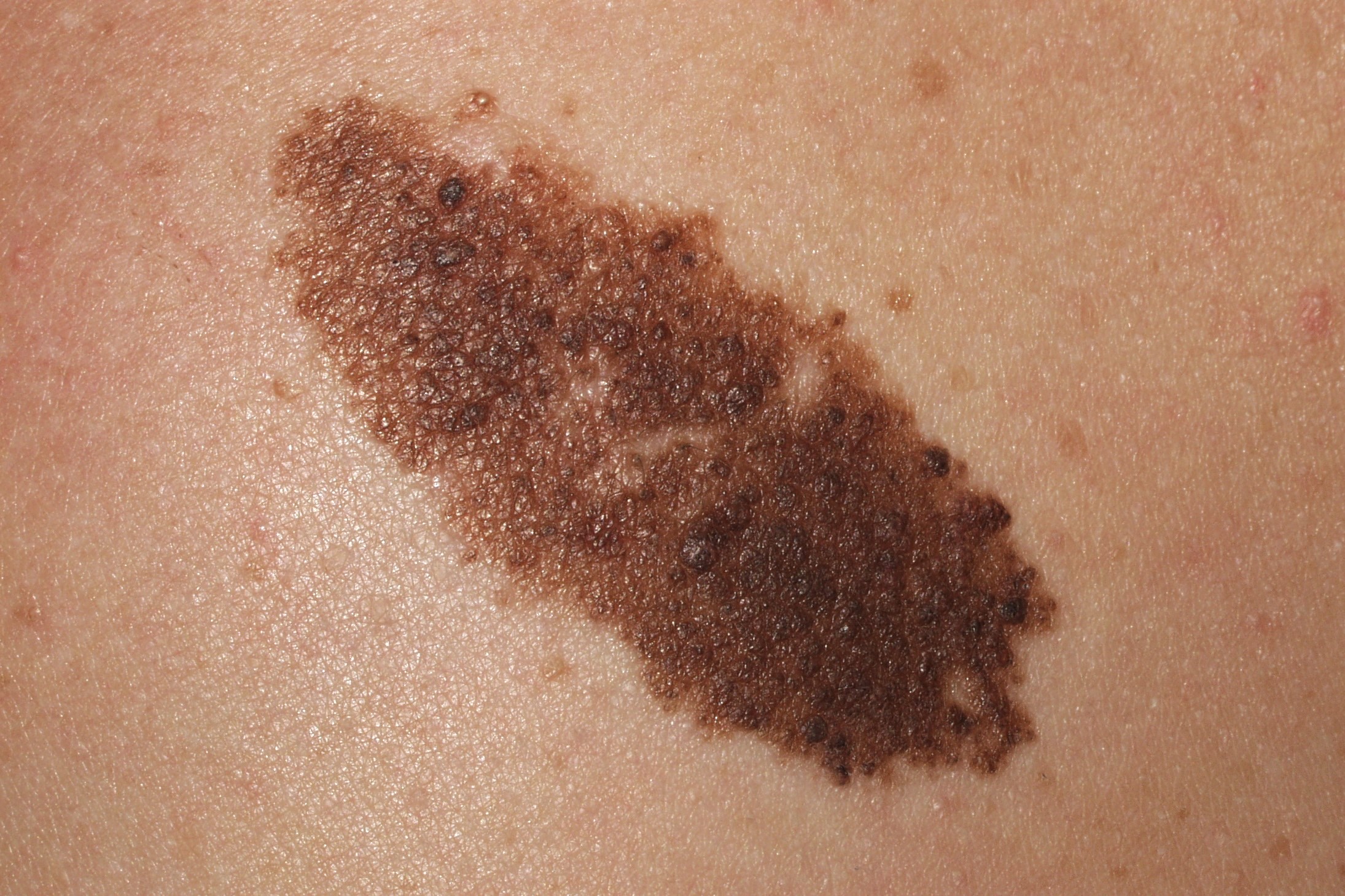 Nevus melanociticos congenito Q82.5; maculopápula pigmentada de borde irregular, policroma de tamaño intermedio, 5 cm (1)