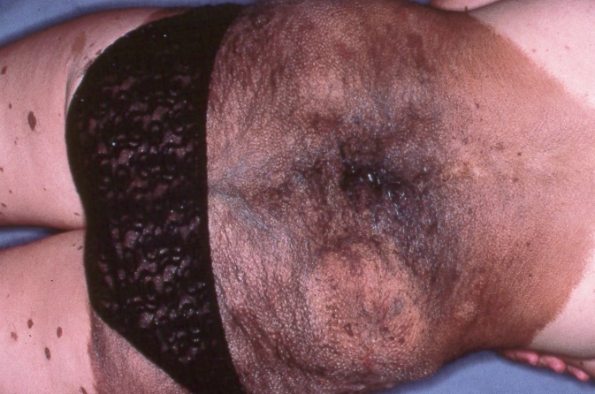 Nevus melanociticos congenito gigante Q82.5; lesión melanocítica de localizacion axial, mayor de 20 cm, policroma e irregular, con  lesiones satélites; riesgo de melanoma (4)