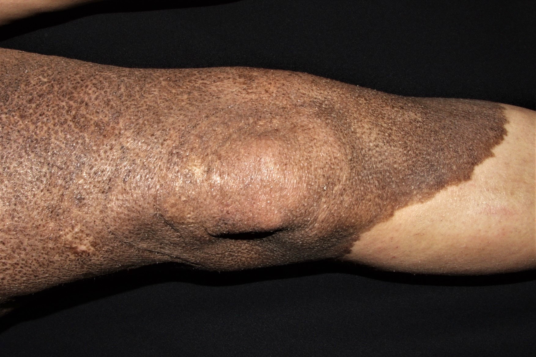Nevus melanociticos congenito gigante Q82.5; lesión melanocítica de localizacion en pierna, mayor de 20 cm, policroma e irregular; riesgo de melanoma (1)