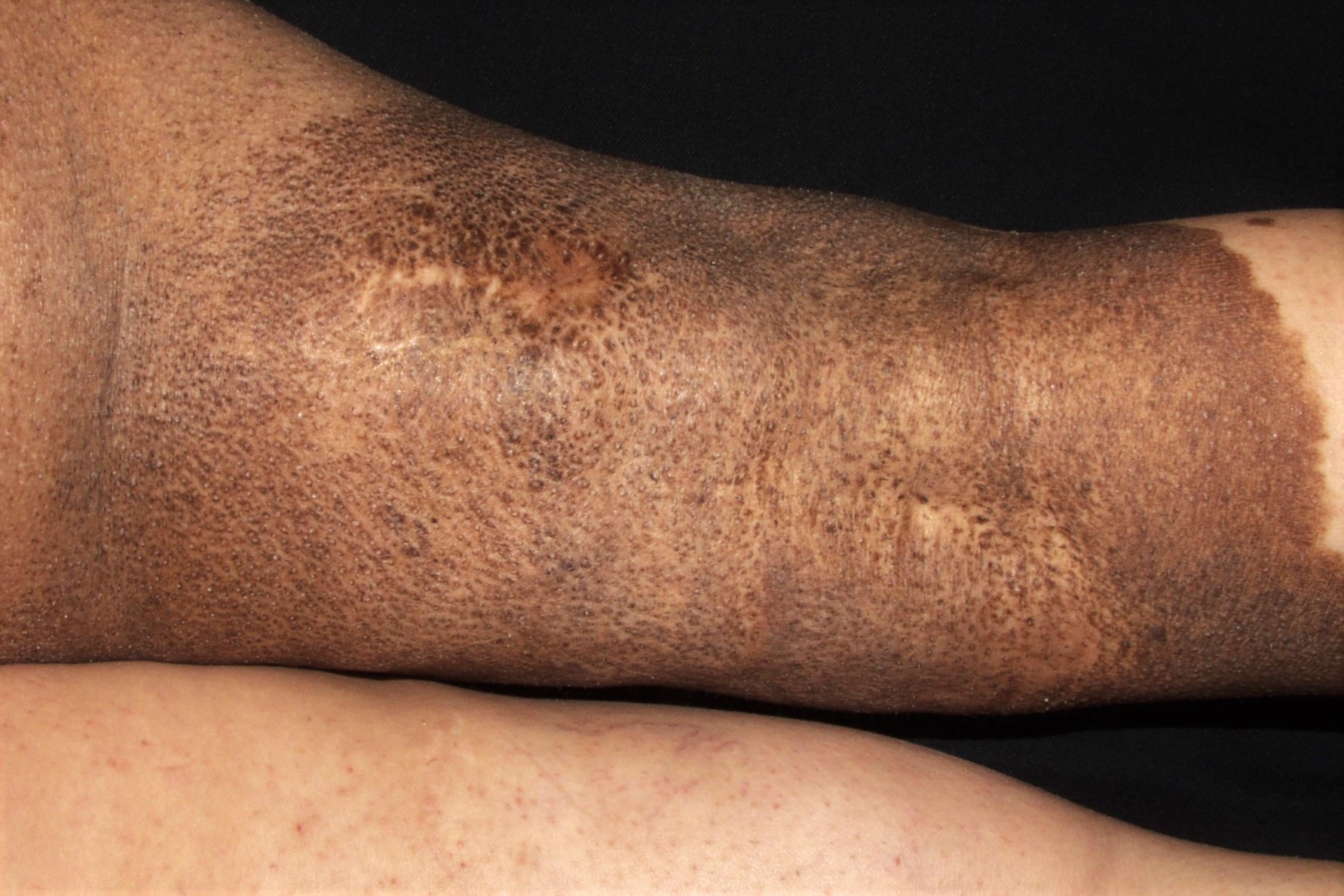 Nevus melanociticos congenito gigante Q82.5; lesión melanocítica de localizacion en pierna, mayor de 20 cm, policroma e irregular; riesgo de melanoma (2)