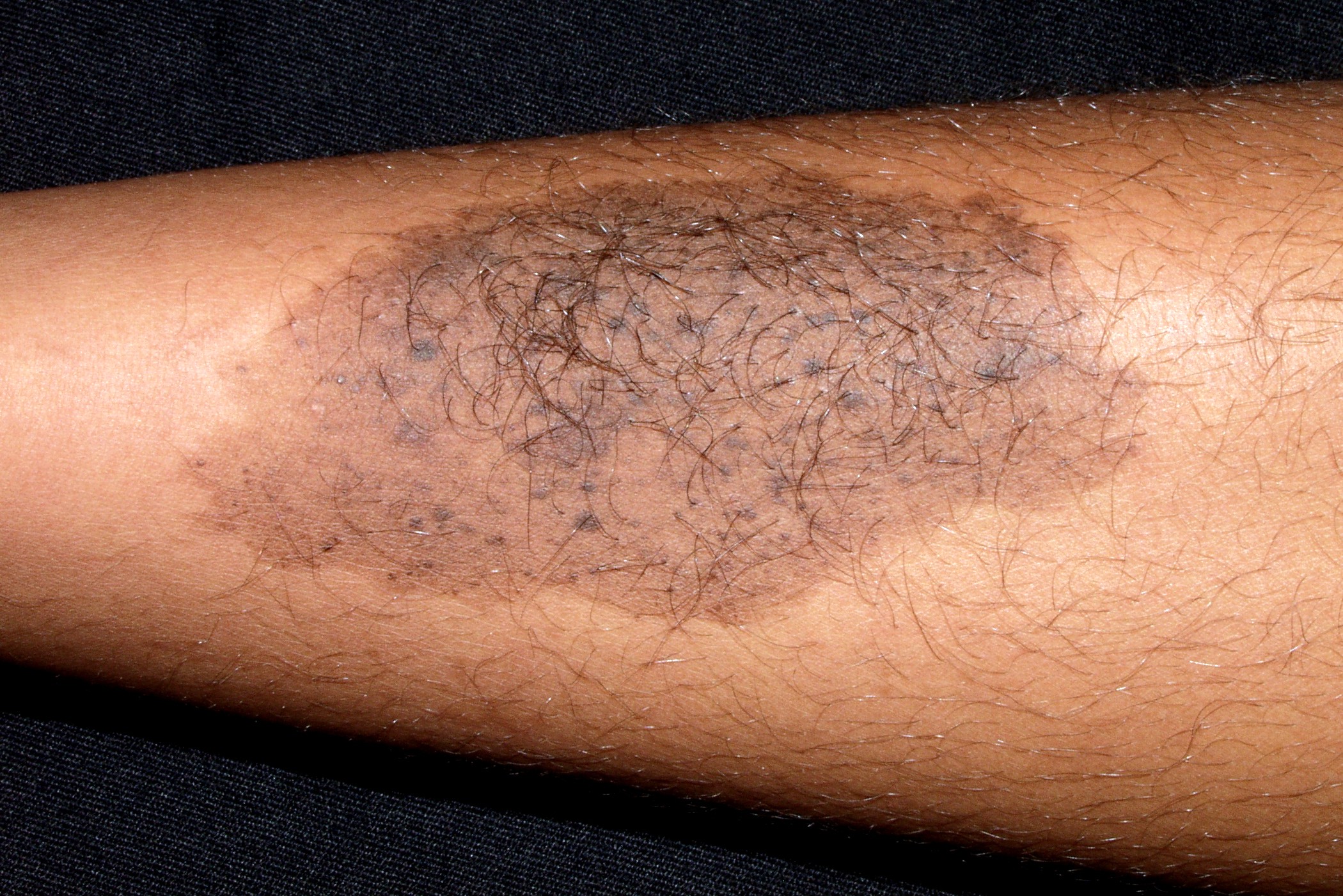 Nevus spilus D22; nevus sobre nevus; mancha café con leche salpicada por docenas de pequeños nevus junturales (1)