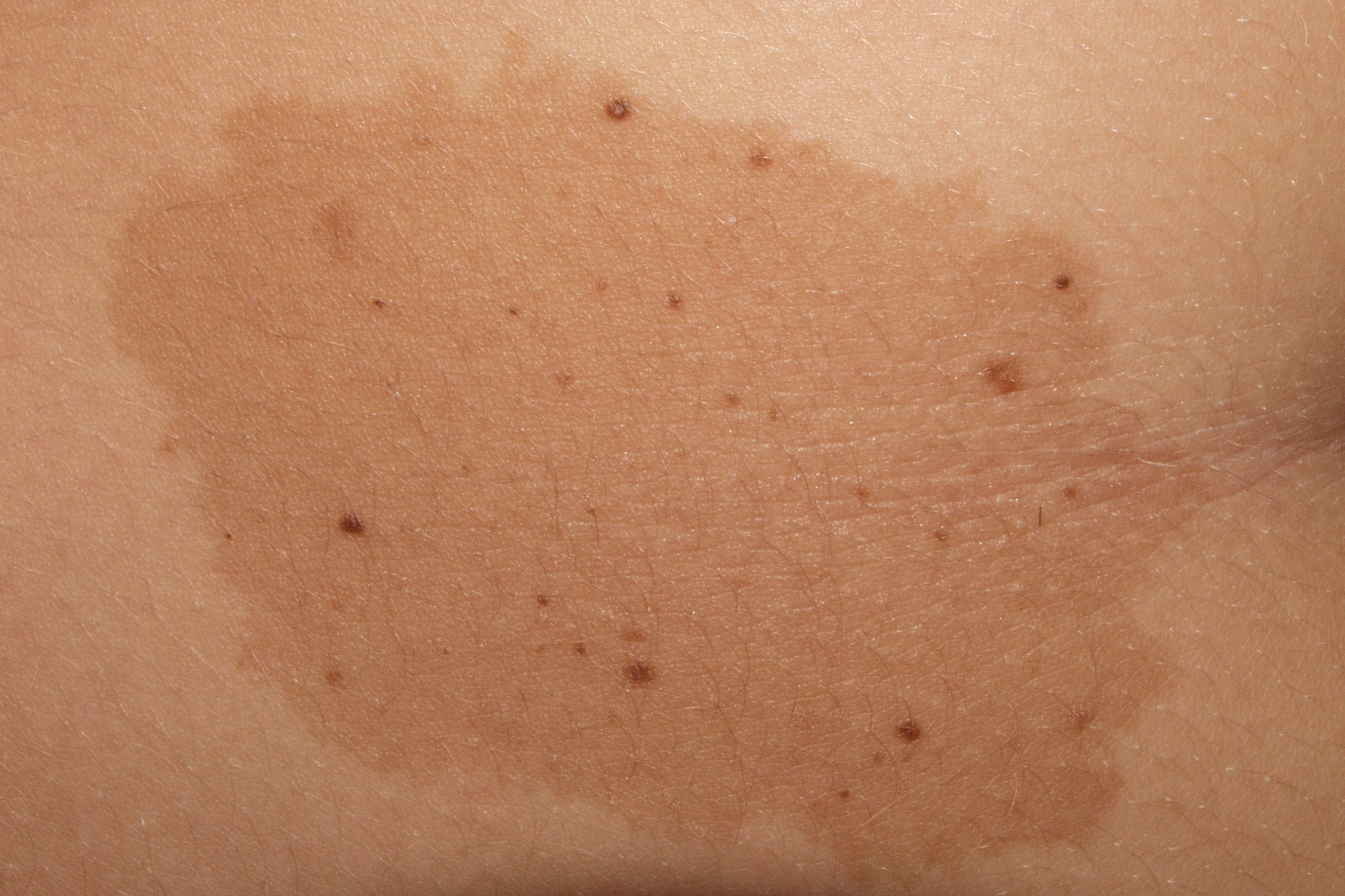 Nevus spilus D22; nevus sobre nevus; mancha café con leche salpicada por docenas de pequeños nevus junturales en dorso (2)