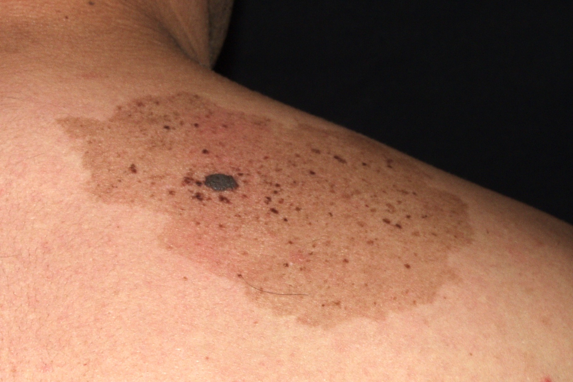 Nevus spilus D22; nevus sobre nevus; mancha café con leche salpicada por docenas de pequeños nevus junturales en parte superior de espalda
