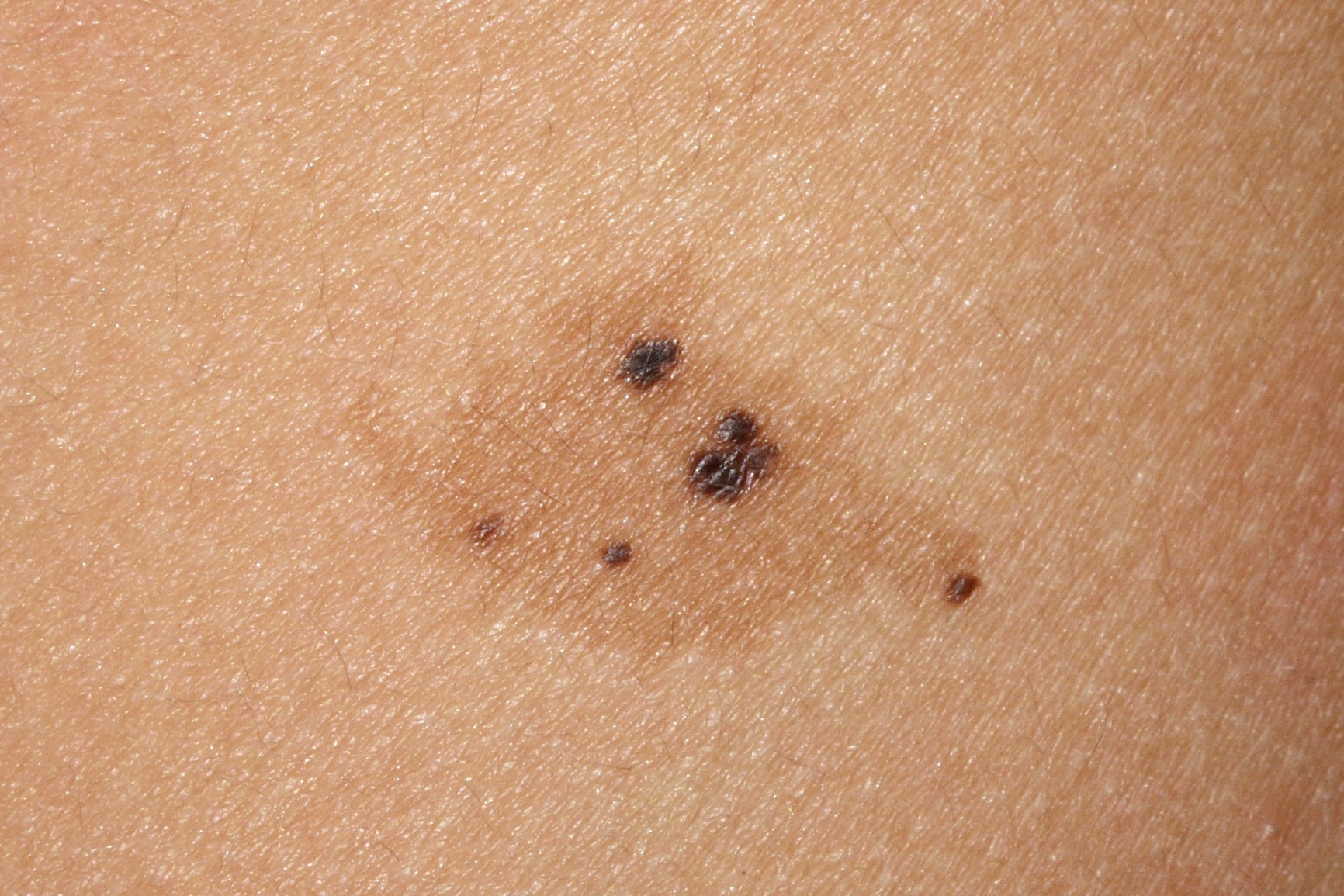 Nevus spilus D22; nevus sobre nevus; mancha café con leche salpicada por docenas de pequeños nevus junturales en región lumbar