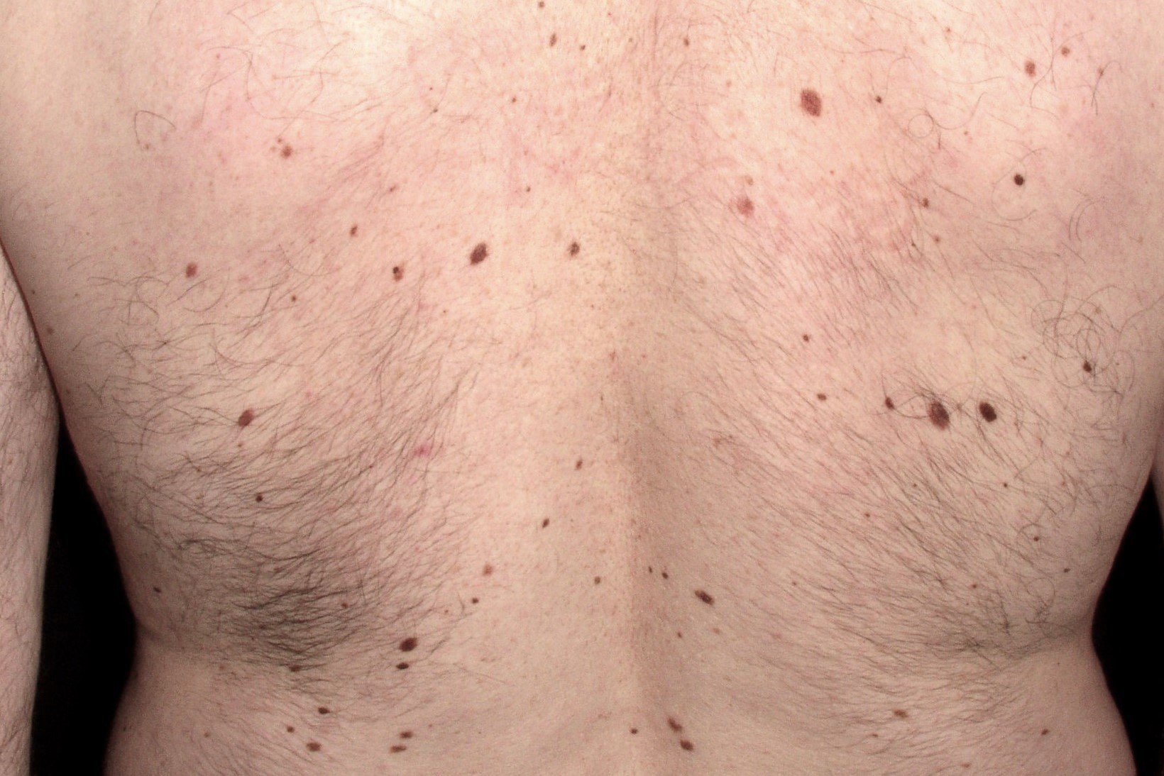 Síndrome del nevus displásico D22; más de 100 nevus de diferentes tamaños, algunos irregulares y de diferentes tonalidades (1)
