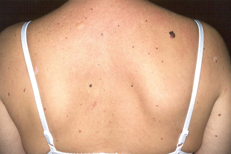 Síndrome del nevus displásico D22; más de 100 nevus de diferentes tamaños, algunos irregulares y de diferentes tonalidades (10)