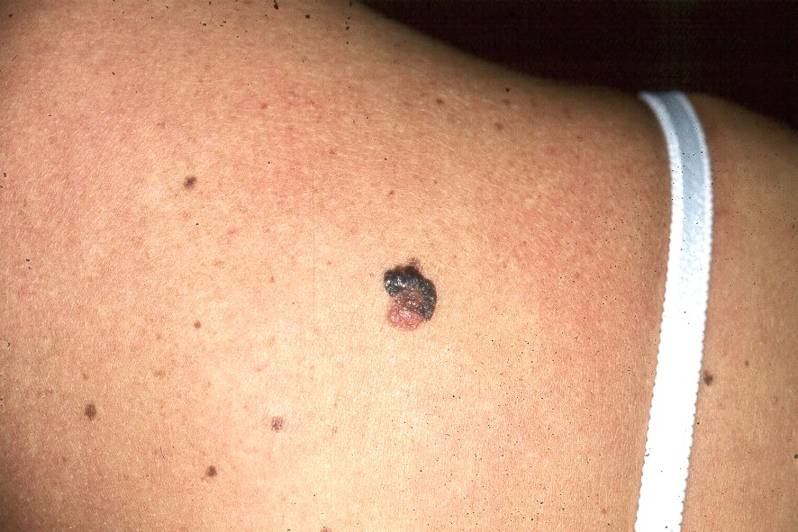 Síndrome del nevus displásico D22; más de 100 nevus de diferentes tamaños, algunos irregulares y de diferentes tonalidades (11)