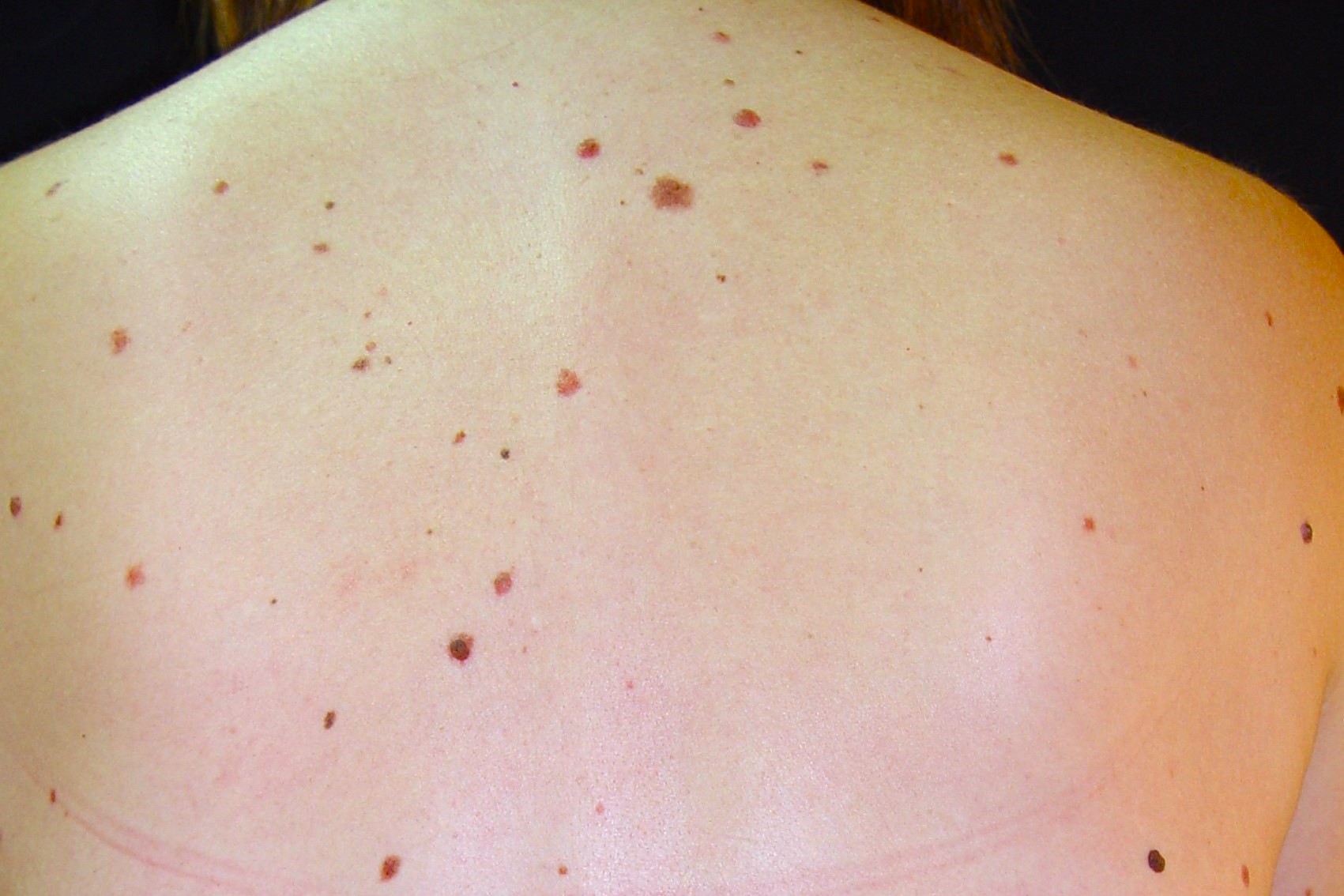 Síndrome del nevus displásico D22; más de 100 nevus de diferentes tamaños, algunos irregulares y de diferentes tonalidades (5)