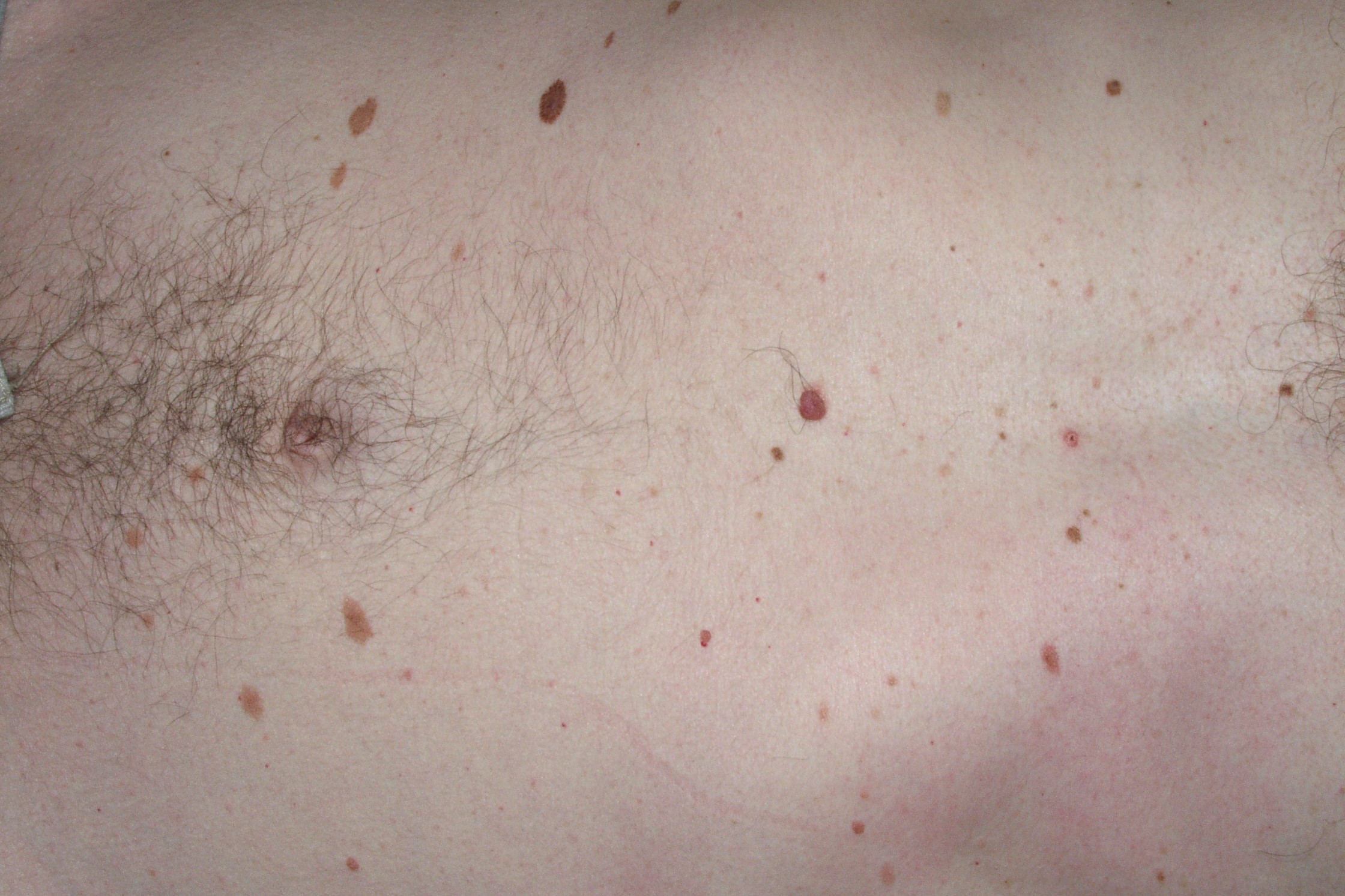 Síndrome del nevus displásico D22; más de 100 nevus de diferentes tamaños, algunos irregulares y de diferentes tonalidades (6)