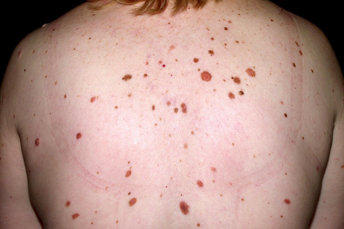 Síndrome del nevus displásico D22; más de 100 nevus de diferentes tamaños, algunos irregulares y de diferentes tonalidades (8)