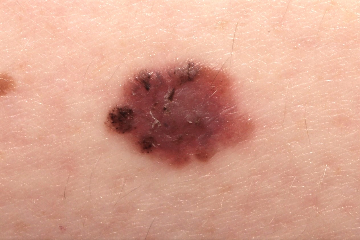 melanoma de extension superficial C43.91; placa pigmentada asimétrica y policroma en muslo; tamaño de 8x6 mm (1)