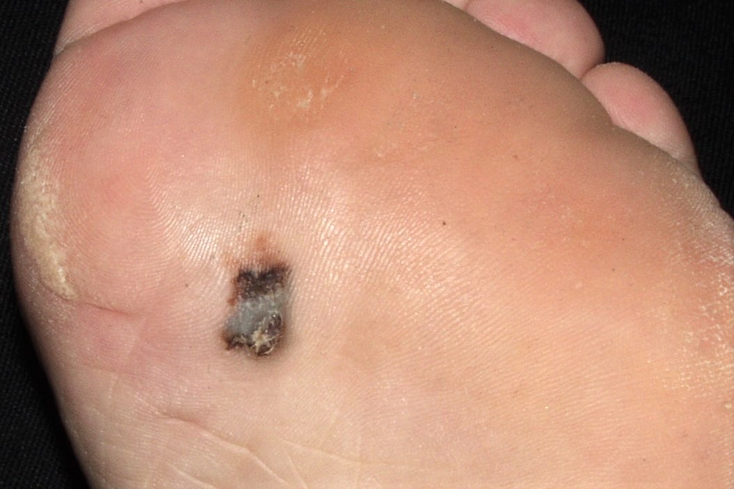 melanoma lentiginoso acral C43.92; mácula hiperpigmentada, bicolor, en la planta del pie de 15x13 mm