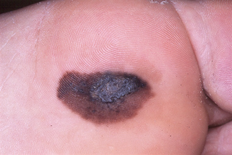 melanoma lentiginoso acral C43.92; mácula hiperpigmentada, bicolor (parte superior papular casi negra), en la planta del pie de 35x19 mm (1)