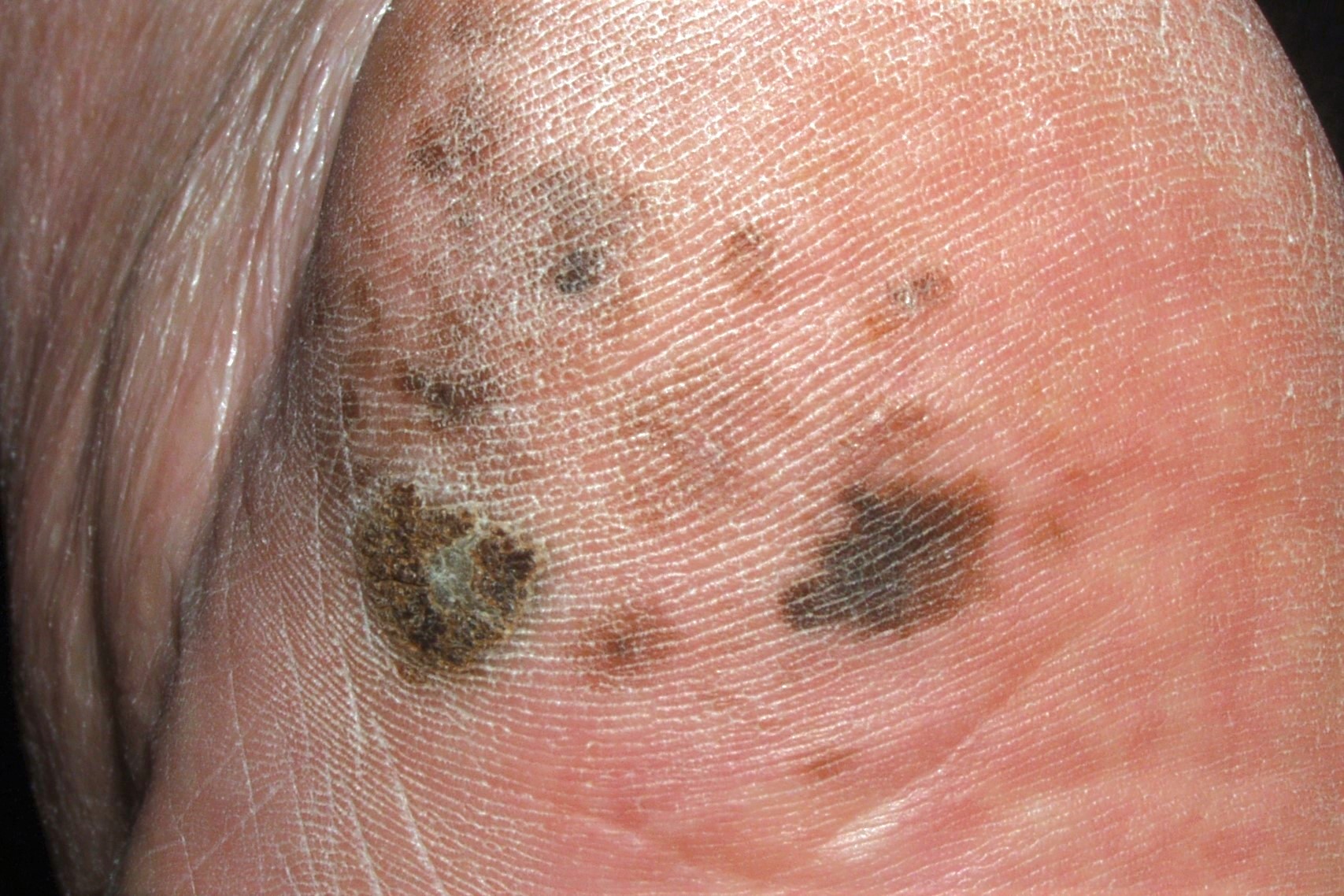 melanoma lentiginoso acral C43.92; mácula hiperpigmentada, policroma, en la planta del pie de 35x19 mm (2)