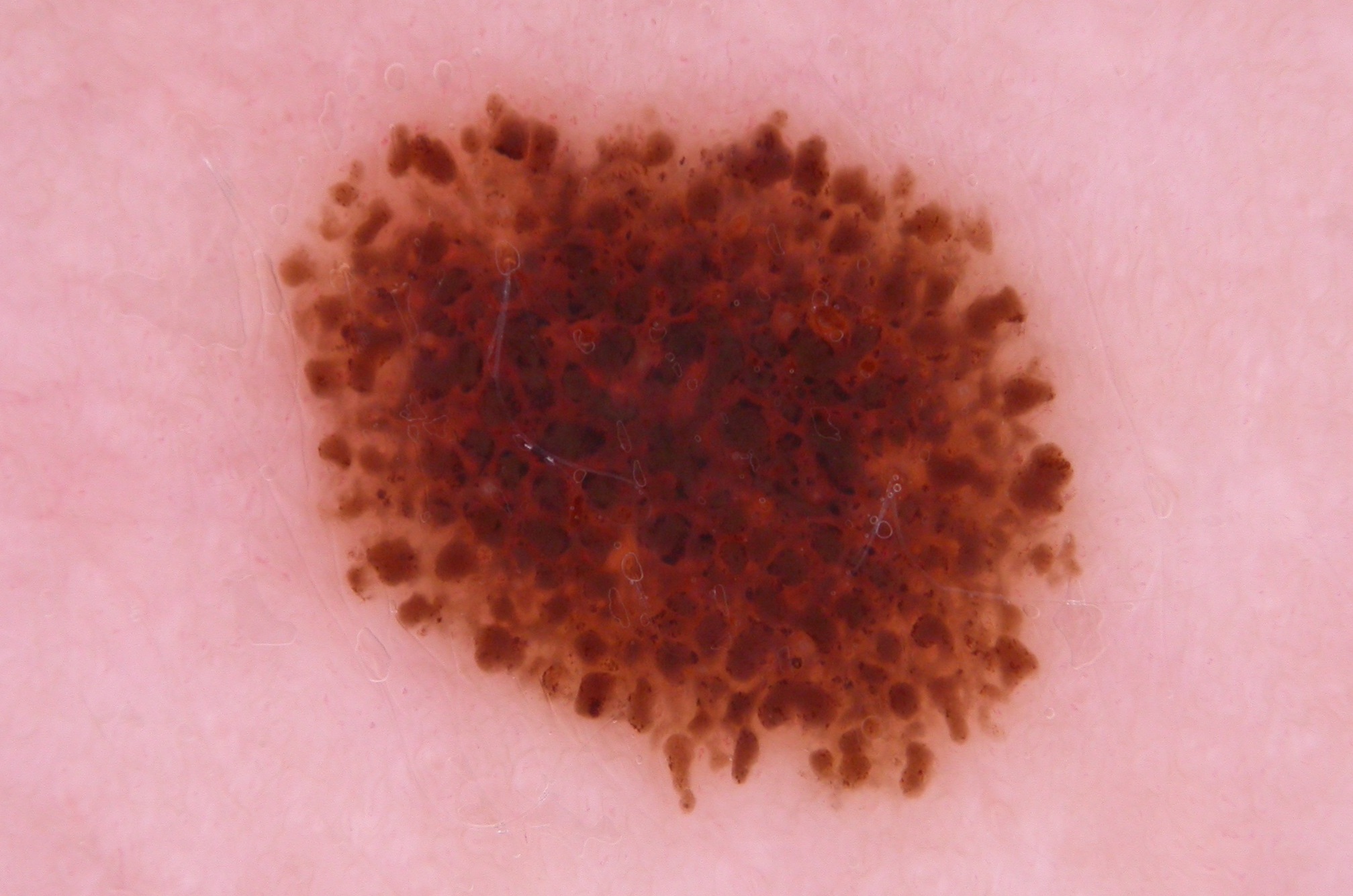 nevus de Reed, dermatoscopia. Patrón en estallido de estrellas (varias filas de glóbulos y pseudópodos simétricos en periferia) 2