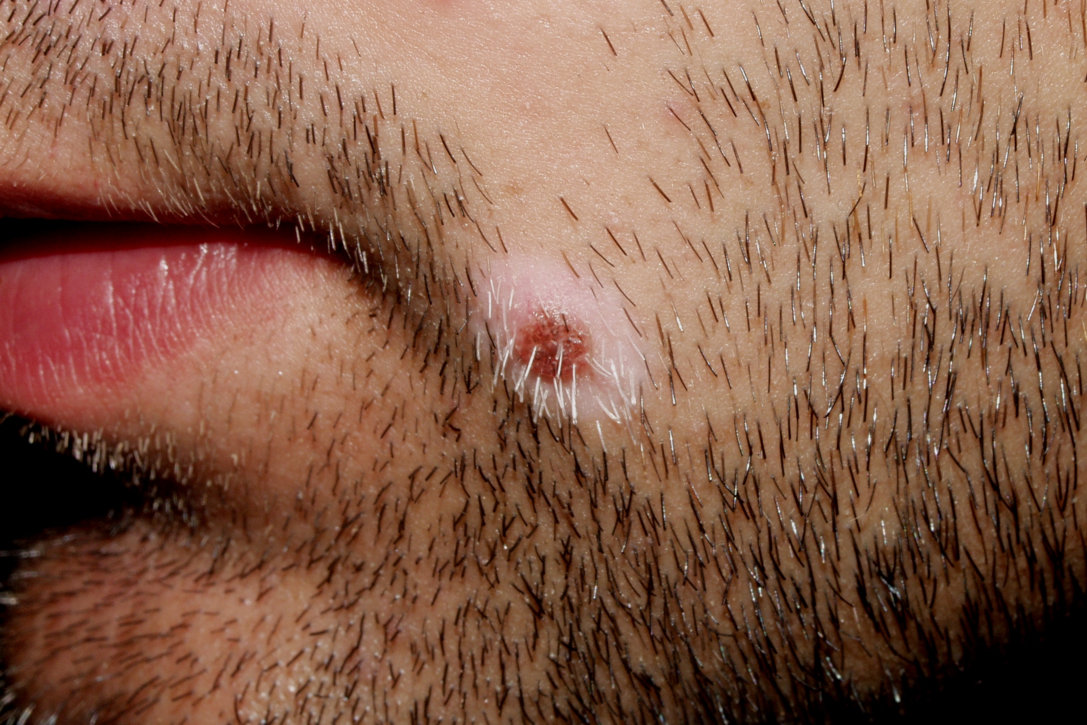 nevus halo; nevus de Sutton; halo de depigmentación alrededor de un nevus común (1)