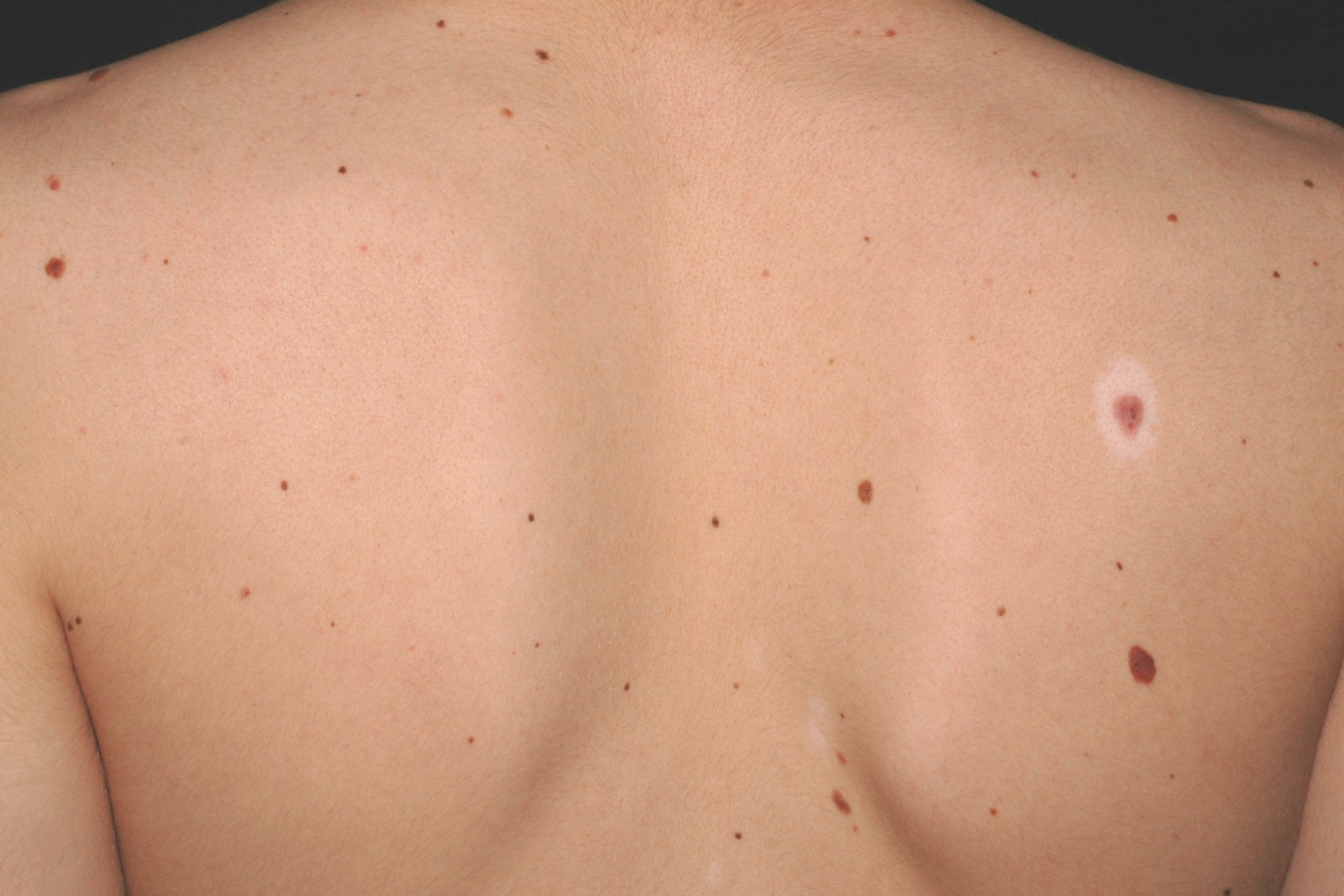 nevus halo; nevus de Sutton; halo de depigmentación alrededor de un nevus común (4)