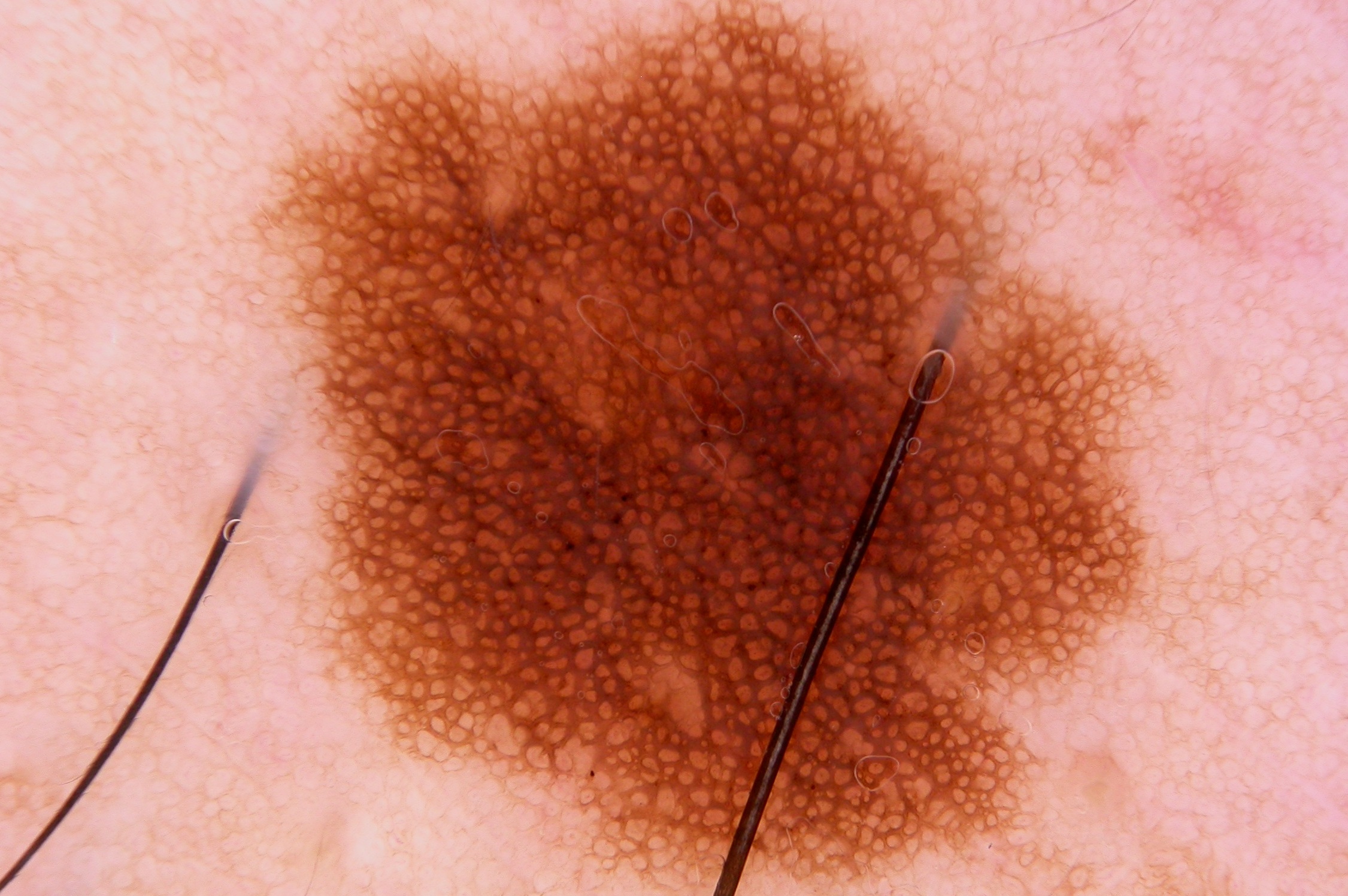 nevus melanocítico común adquido juntural, dermatoscopia; patrón reticular típico difuso