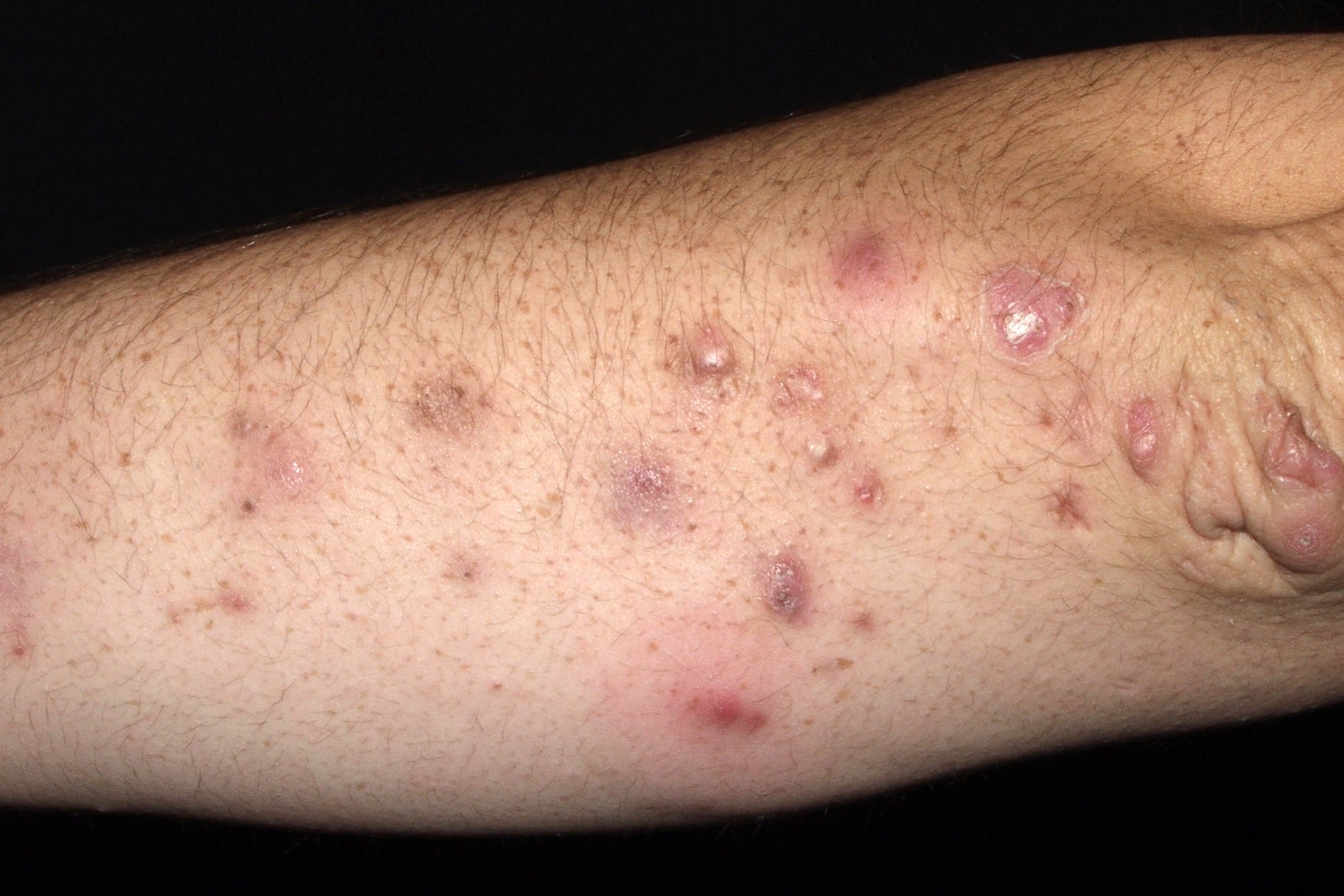 1Colagenosis perforante reactiva L87.1; pápulas queratósicas en los codos, muy pruriginosas en un paciente sometido a hemodiálisis
