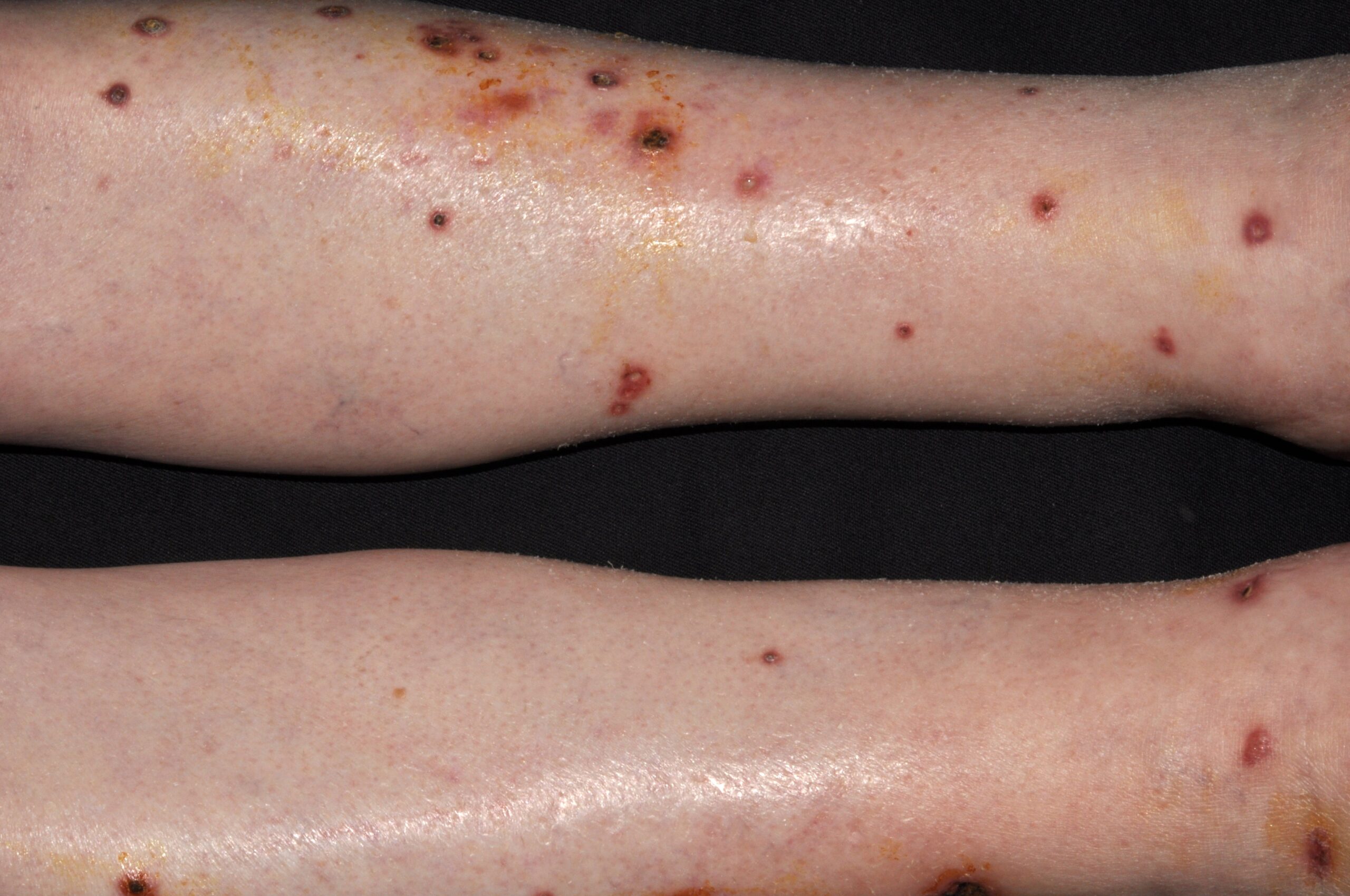 1Colagenosis perforante reactiva L87.1; pápulas queratósicas intensamente pruriginosas dispersas en las extremidades inferiores con un tapón córneo central