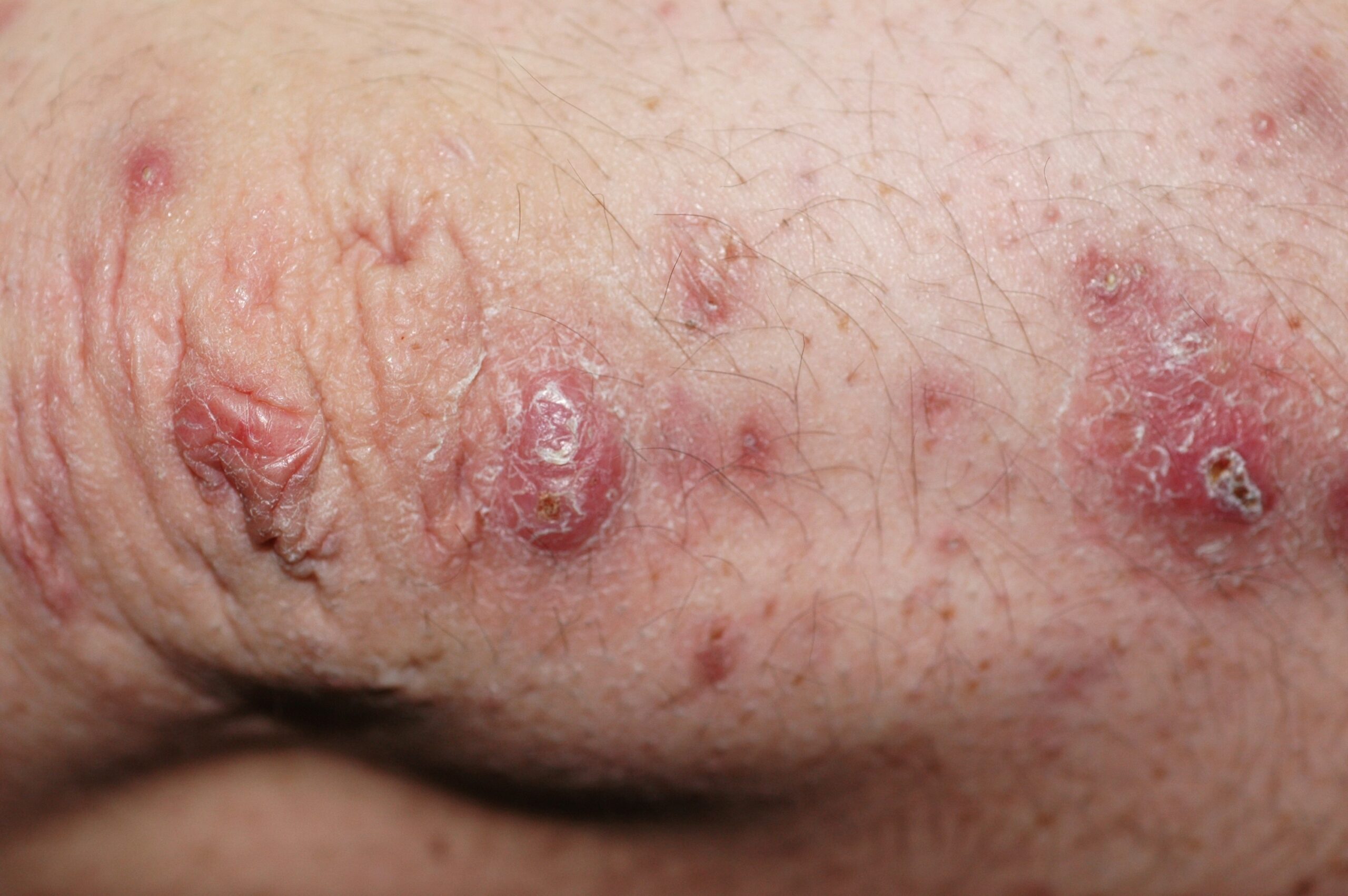 1Colagenosis perforante reactiva L87.1; pápulas queratósicas y papulonódulos ulcerados en las rodillas con histologia de eleminación transepidérmica de colágeno en un paciente con síndrome de Ehlers-D