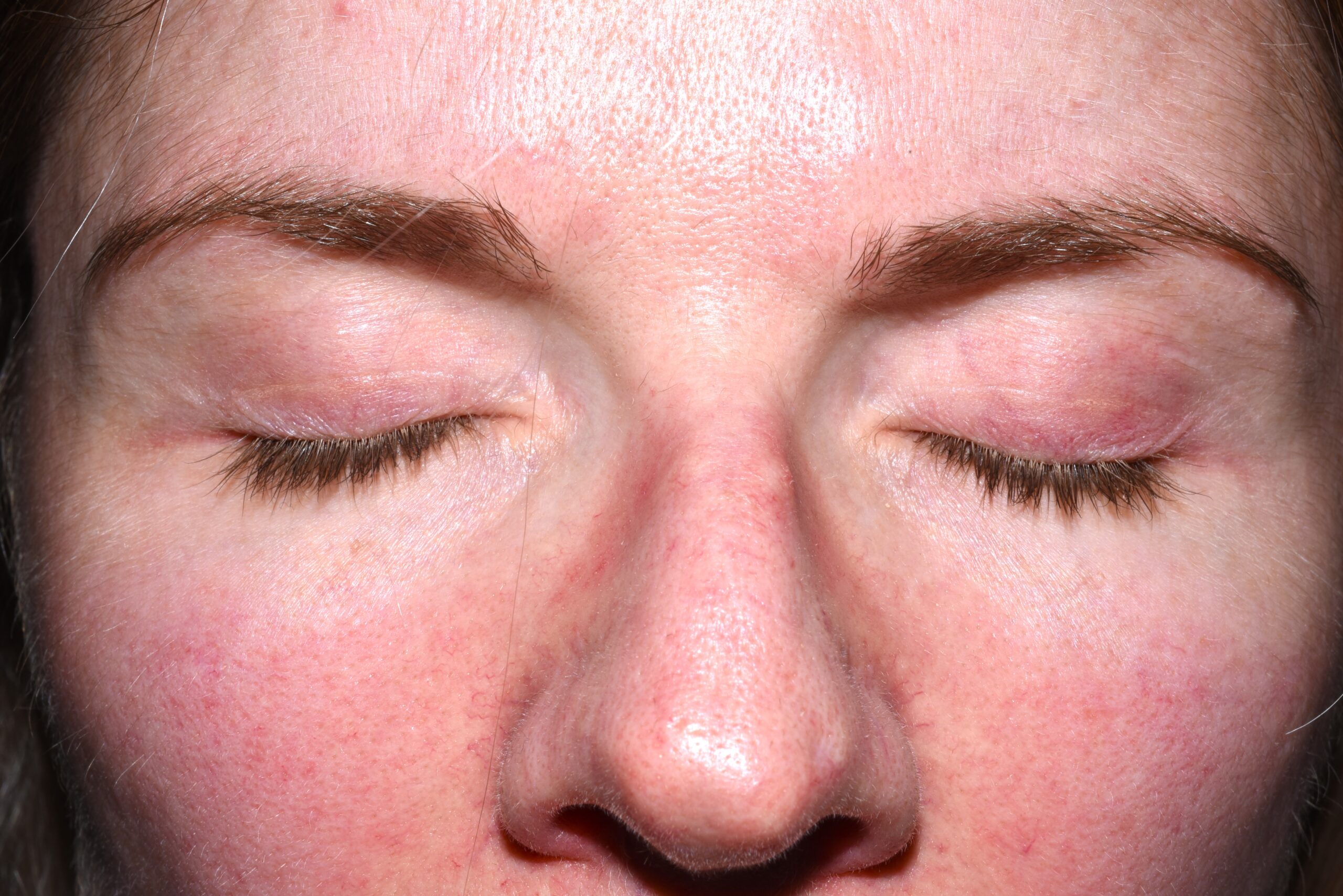 1Dermatomiositis clásica M33.10; erupción eritematoviolacea facial fotosensible, que simula LE, discreto rash eritematovioláceo palpebral (1)