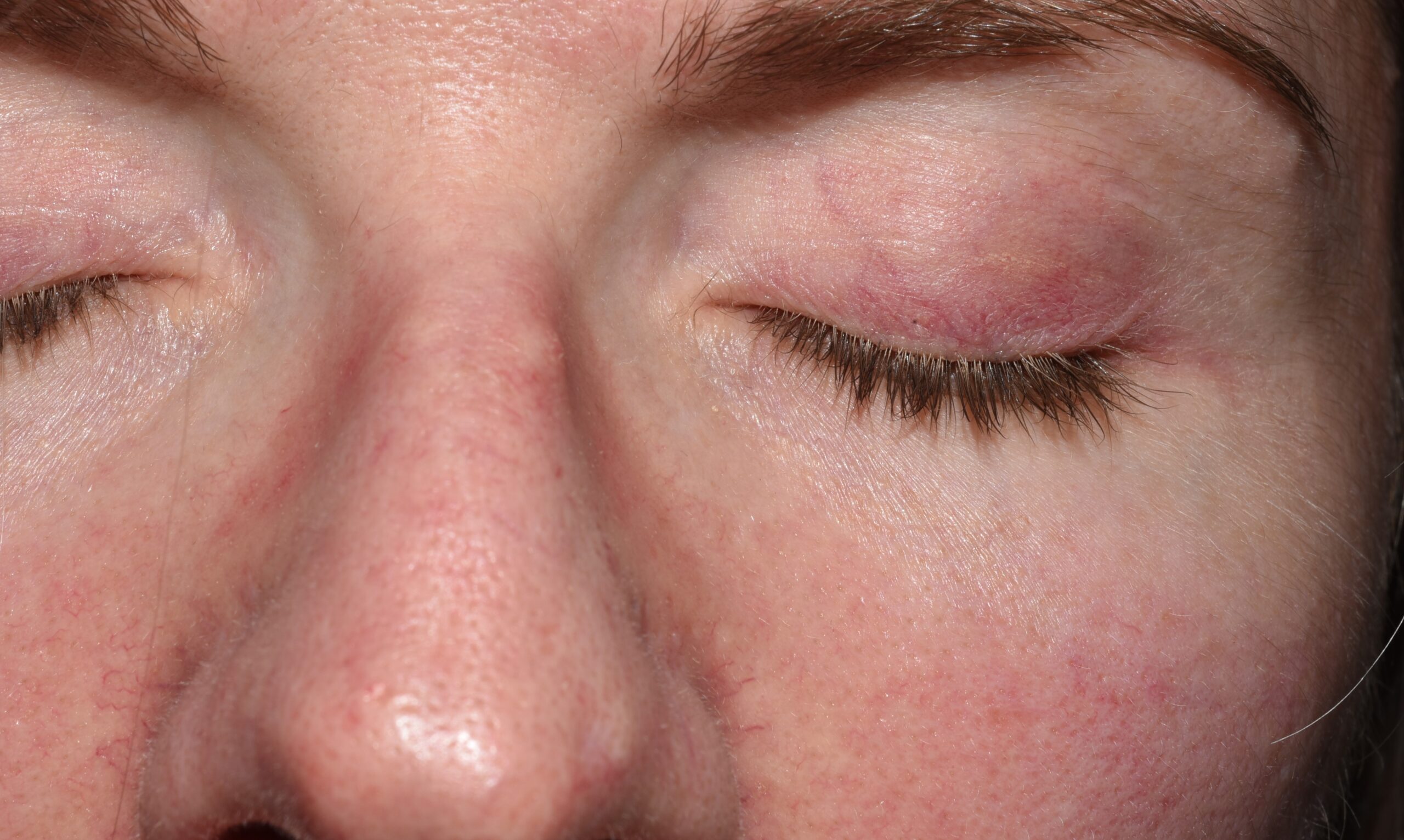 1Dermatomiositis clásica M33.10; erupción eritematoviolacea facial fotosensible, que simula LE, discreto rash eritematovioláceo palpebral (2)