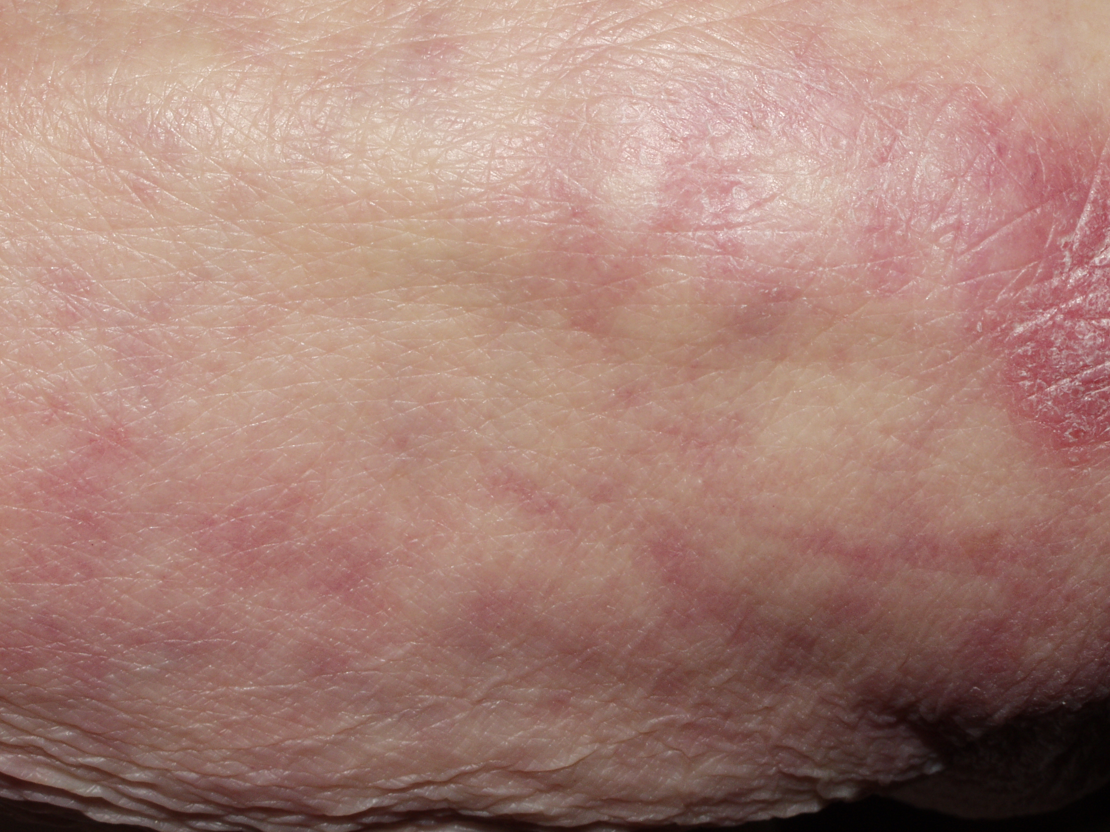 1Dermatomiositis clásica M33.10; lesiones en los codos y livedo reticular en antebrazos (paciente anterior)