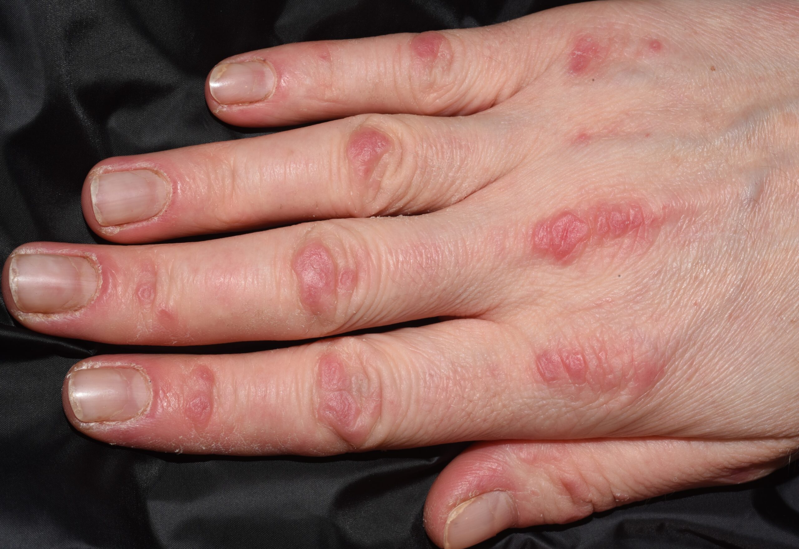 1Dermatomiositis clásica M33.10; pápulas eritematovioláceas sobre los nudillos (Gottron) (3)