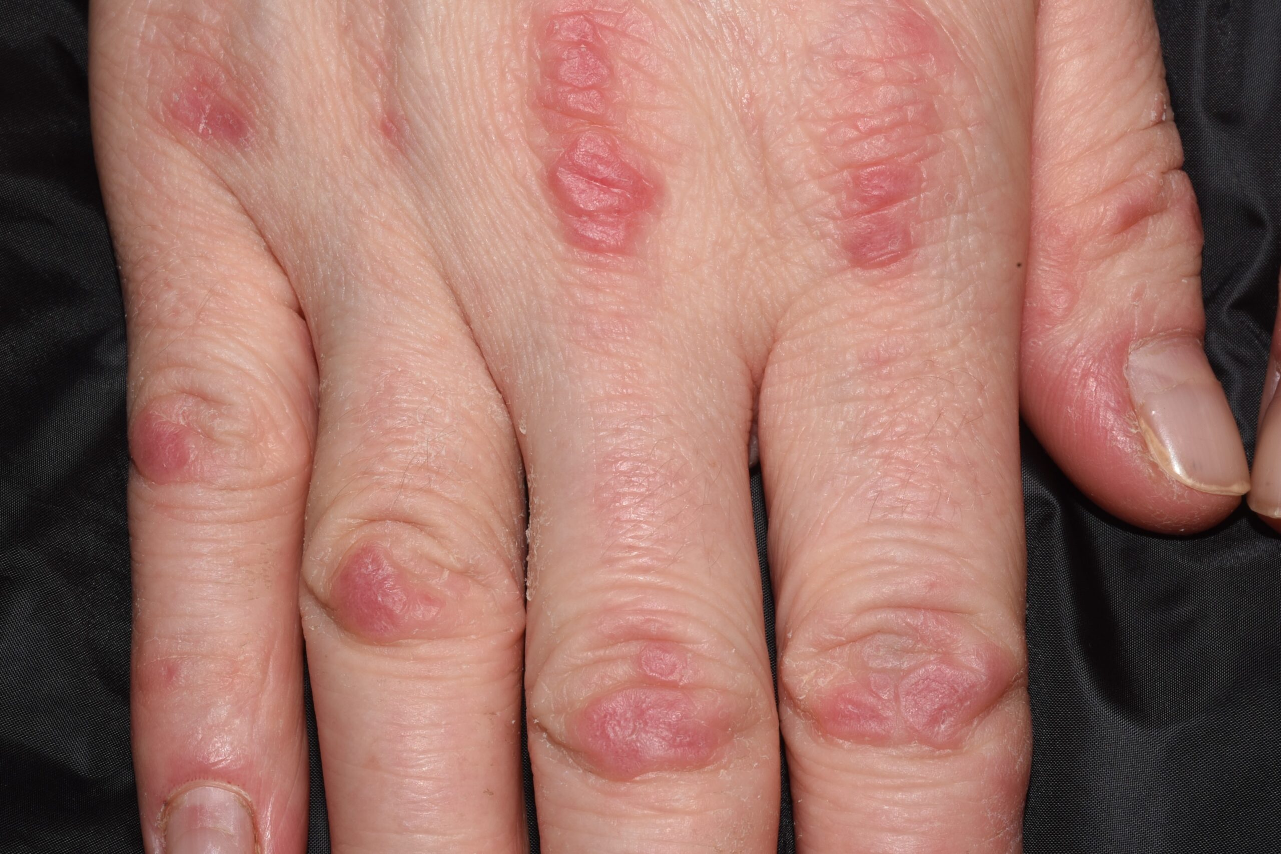 1Dermatomiositis clásica M33.10; pápulas eritematovioláceas sobre los nudillos (Gottron)1 (1)