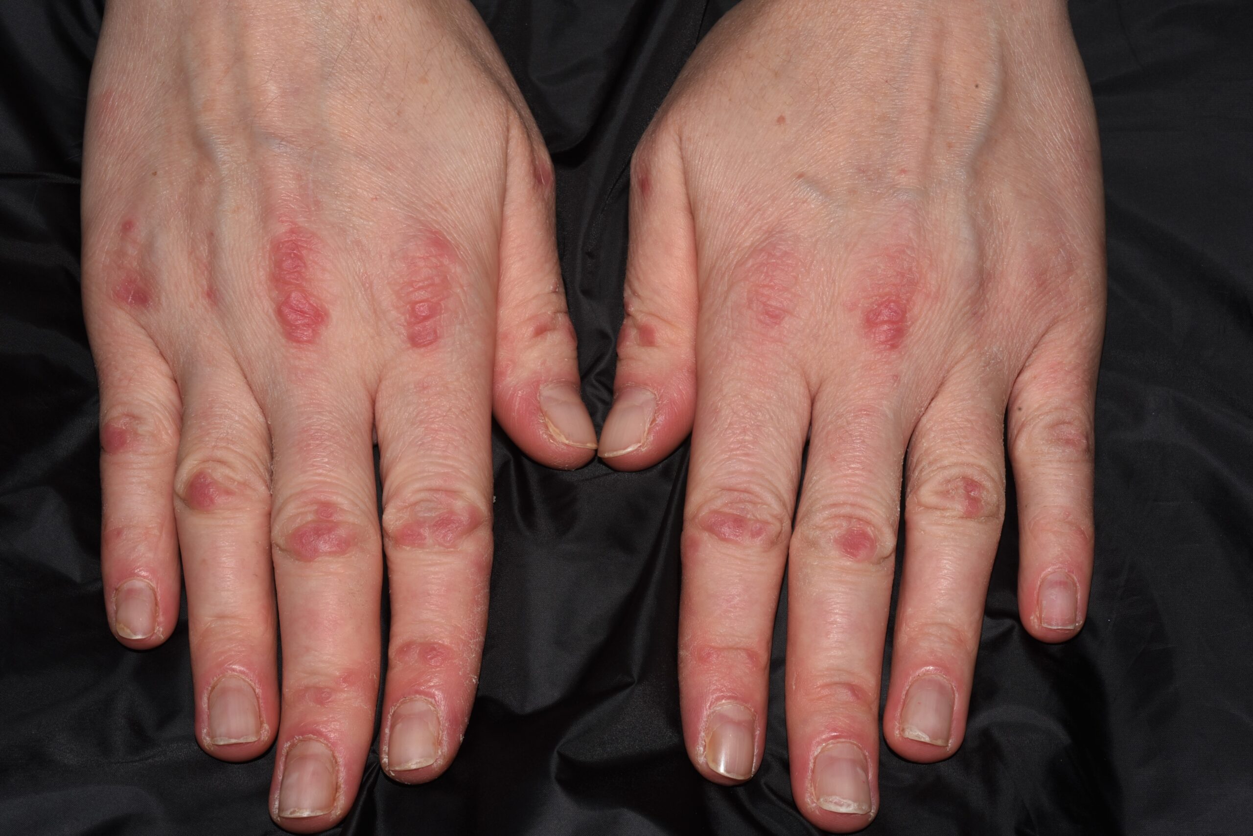 1Dermatomiositis clásica M33.10; pápulas eritematovioláceas sobre los nudillos (Gottron)1 (3)