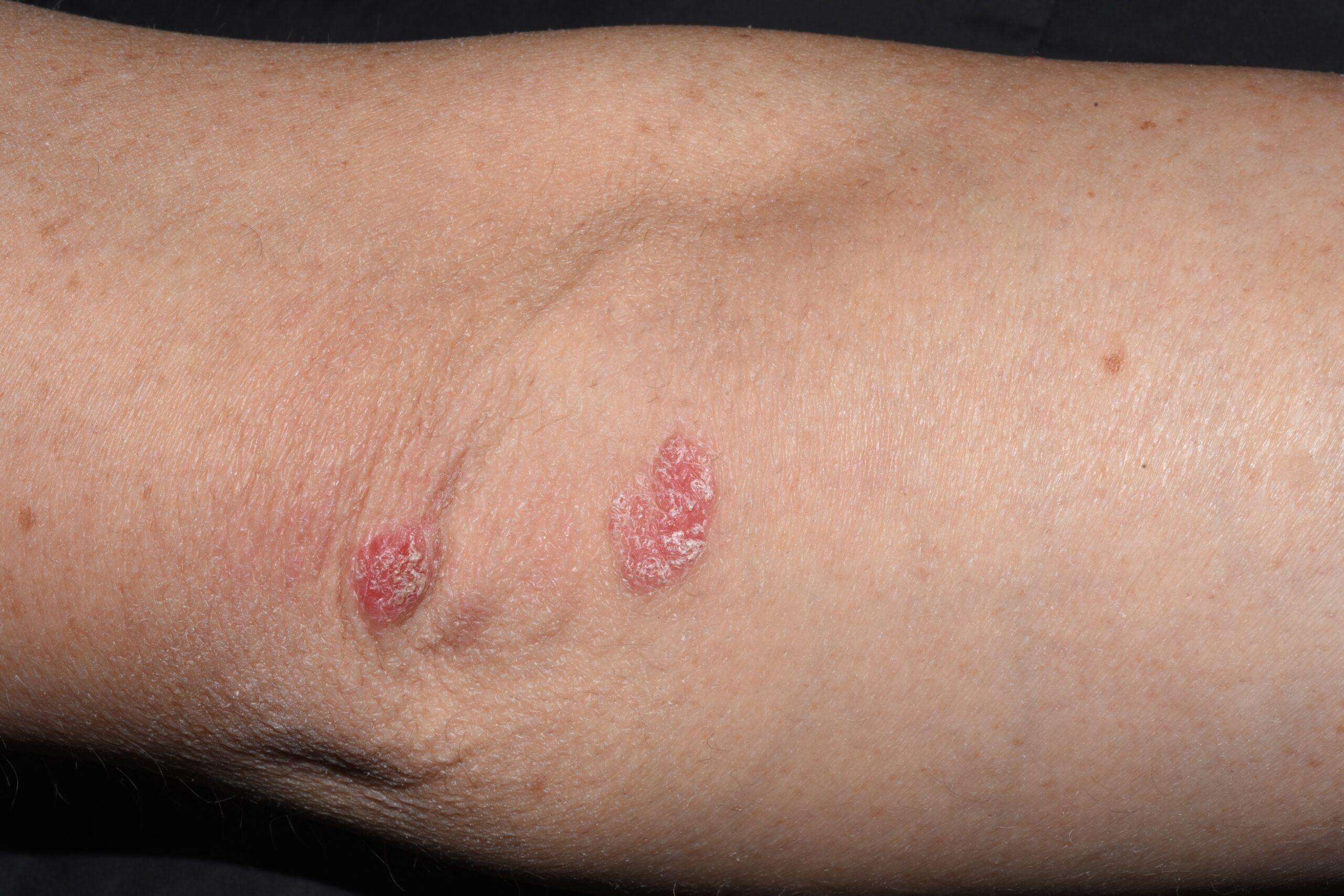 1Dermatomiositis clásica M33.10; placas eritematovioláceas psoriasiformes sobre los codos (Gottron)
