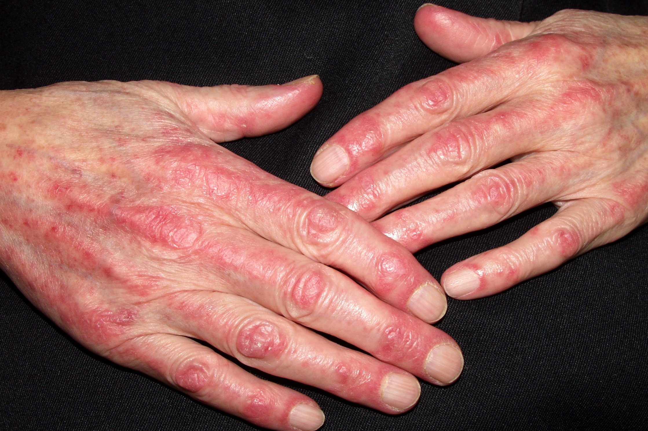 1Dermatomiositis clásica M33.10; signo de Gottron y telangiectasias periungueales (paciente anterior)1 (1)