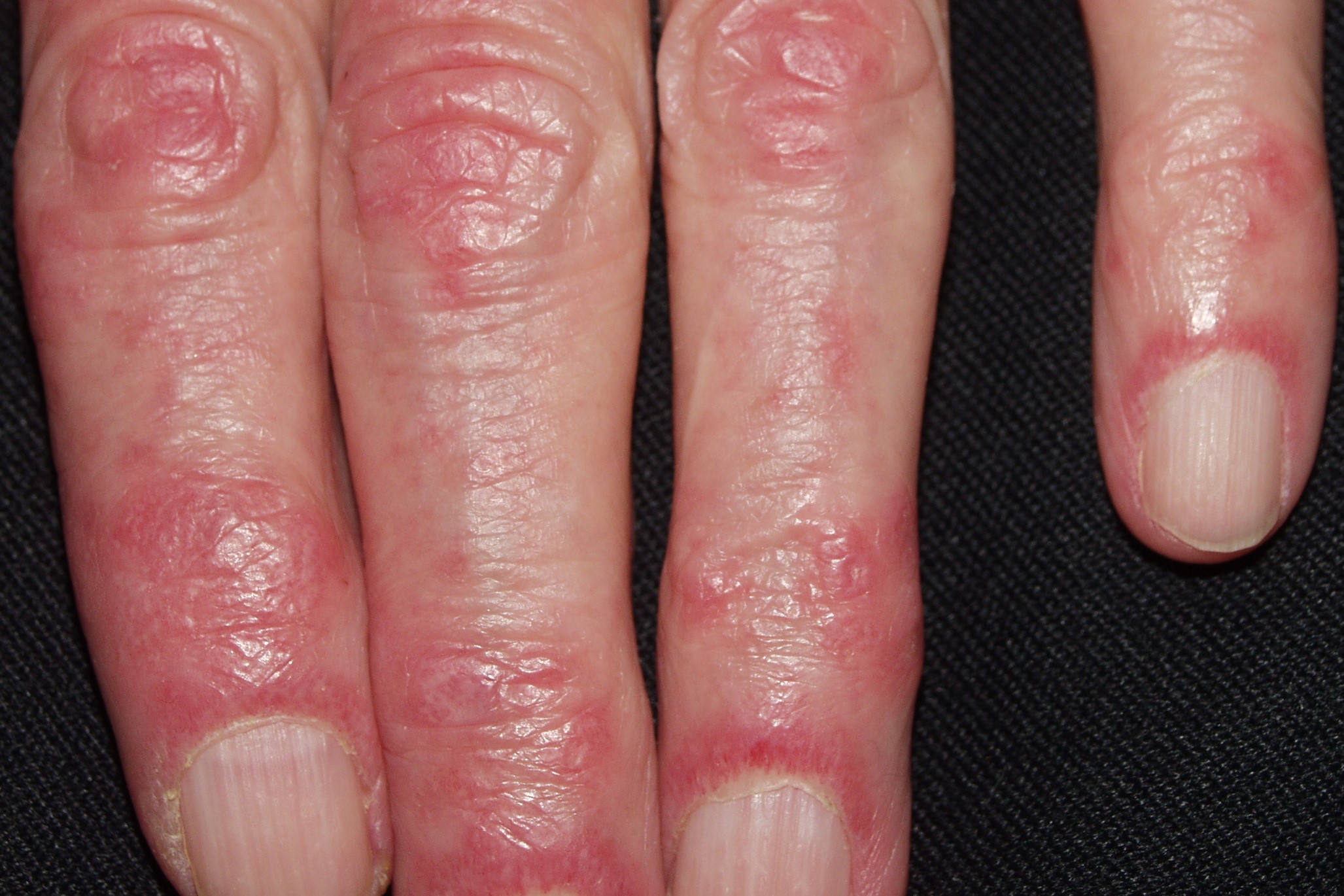 1Dermatomiositis clásica M33.10; signo de Gottron y telangiectasias periungueales (paciente anterior)1 (3)