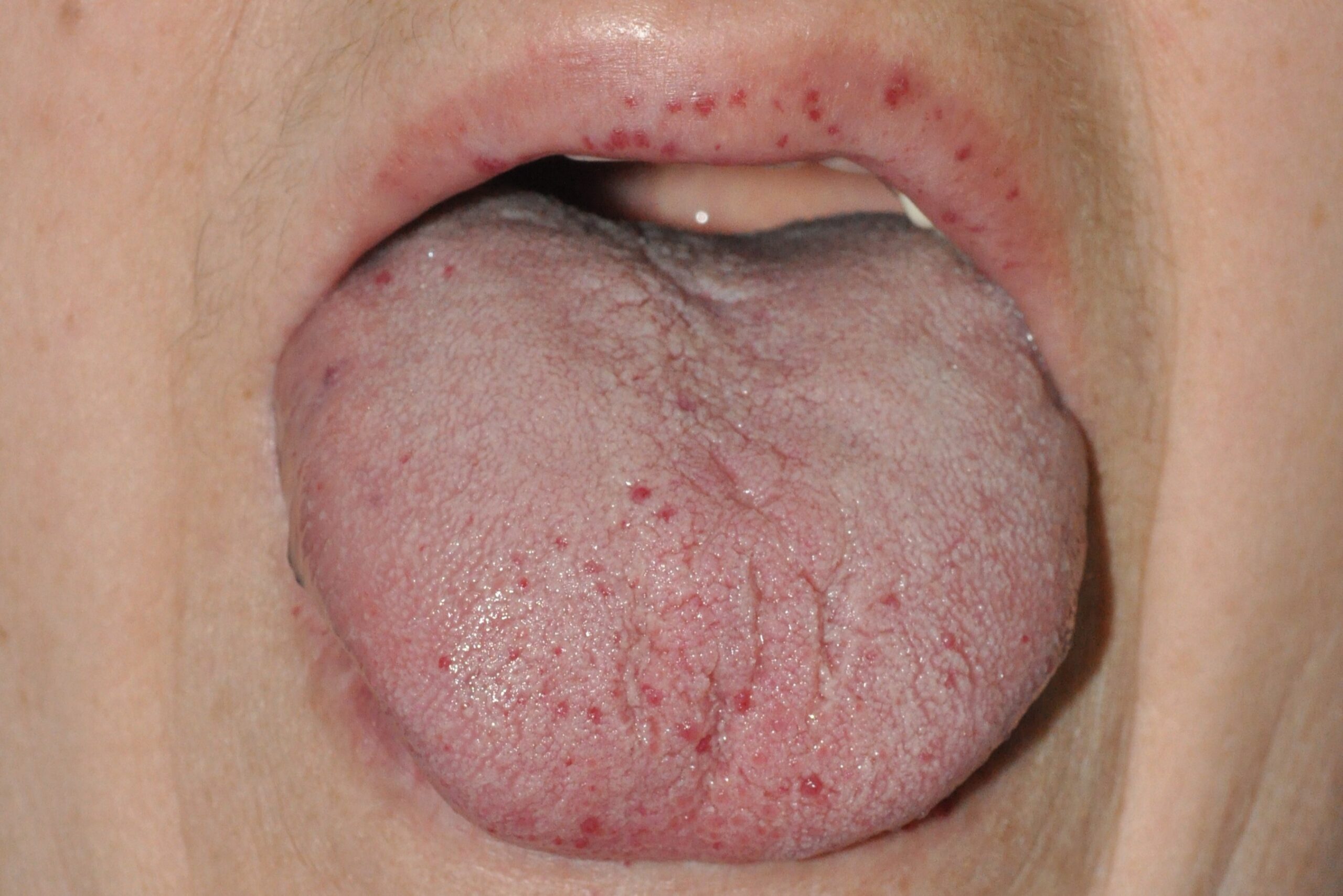 1Enfermedad de Rendu Osler I78.0; múltiples lesiones angiomatoasas (malformaciones arterior-venosas) en la lengua y los labios