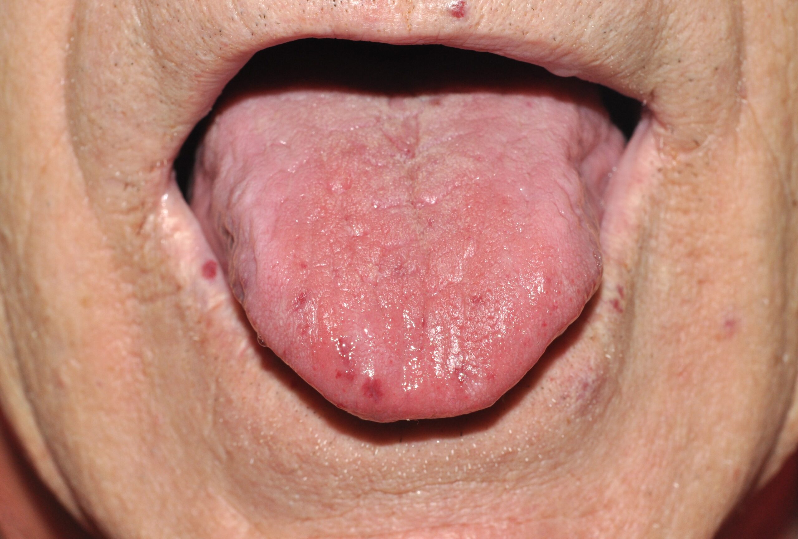 1Enfermedad de Rendu Osler I78.0; múltiples lesiones angiomatoasas (malformaciones arterior-venosas) en la lengua1 (1)