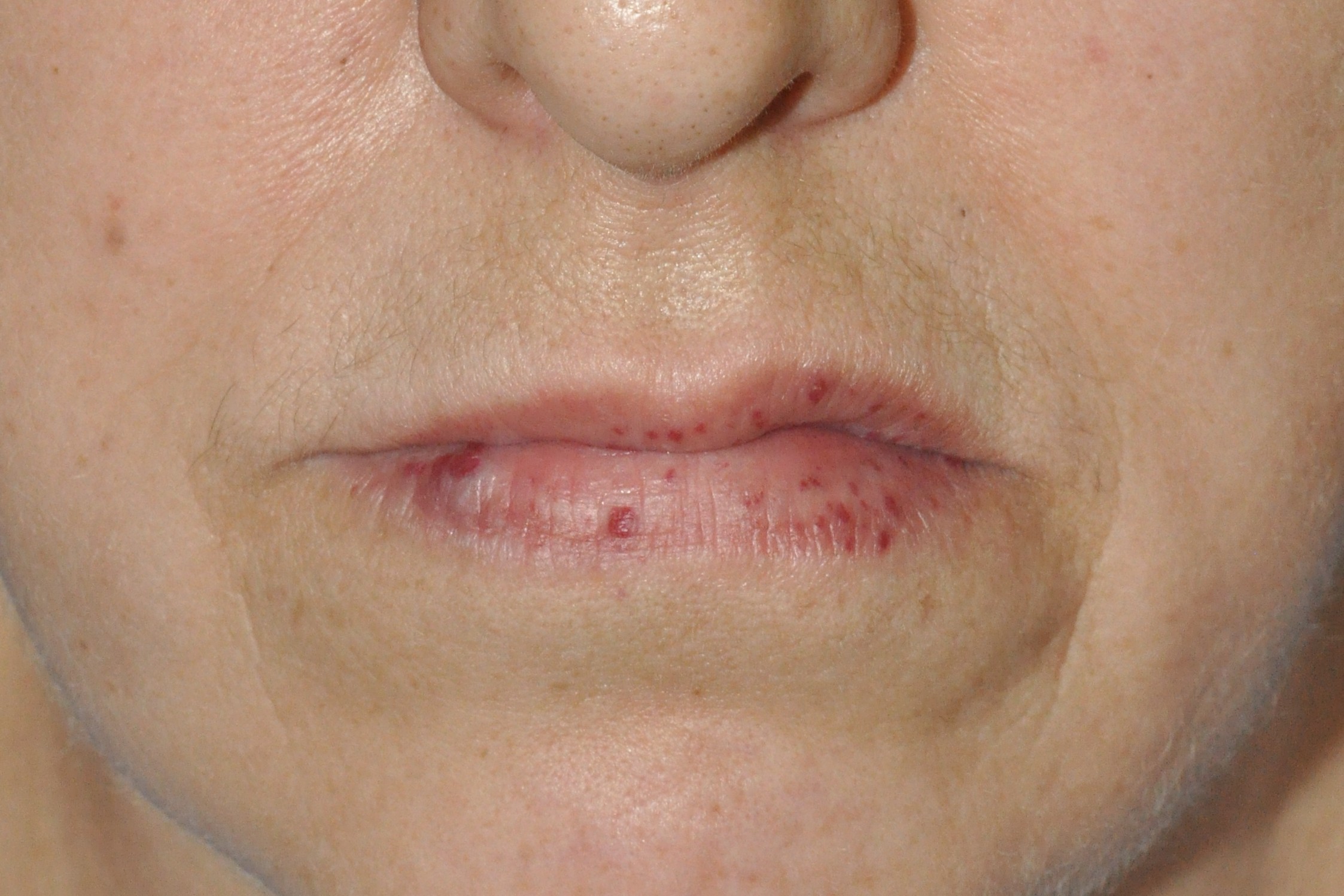 1Enfermedad de Rendu Osler I78.0; múltiples malformaciones arteriovenosas en los labios