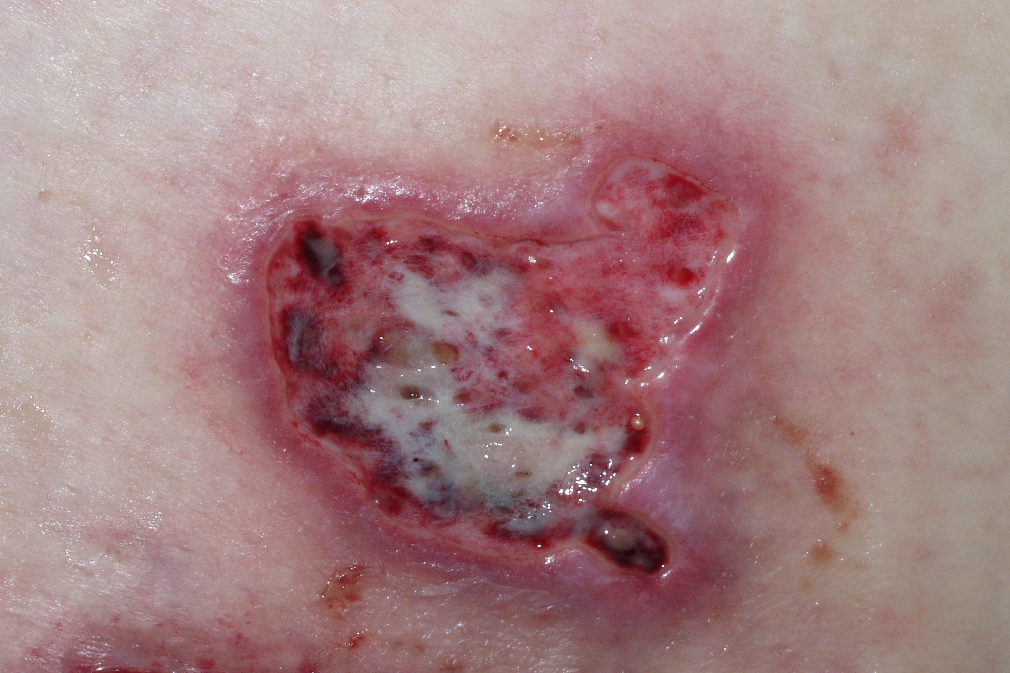 1Pioderma gangrenoso L88; lesión ulcerada, intensamente dolorosa, de bordes geográficos y socavados de color violáceo (1)