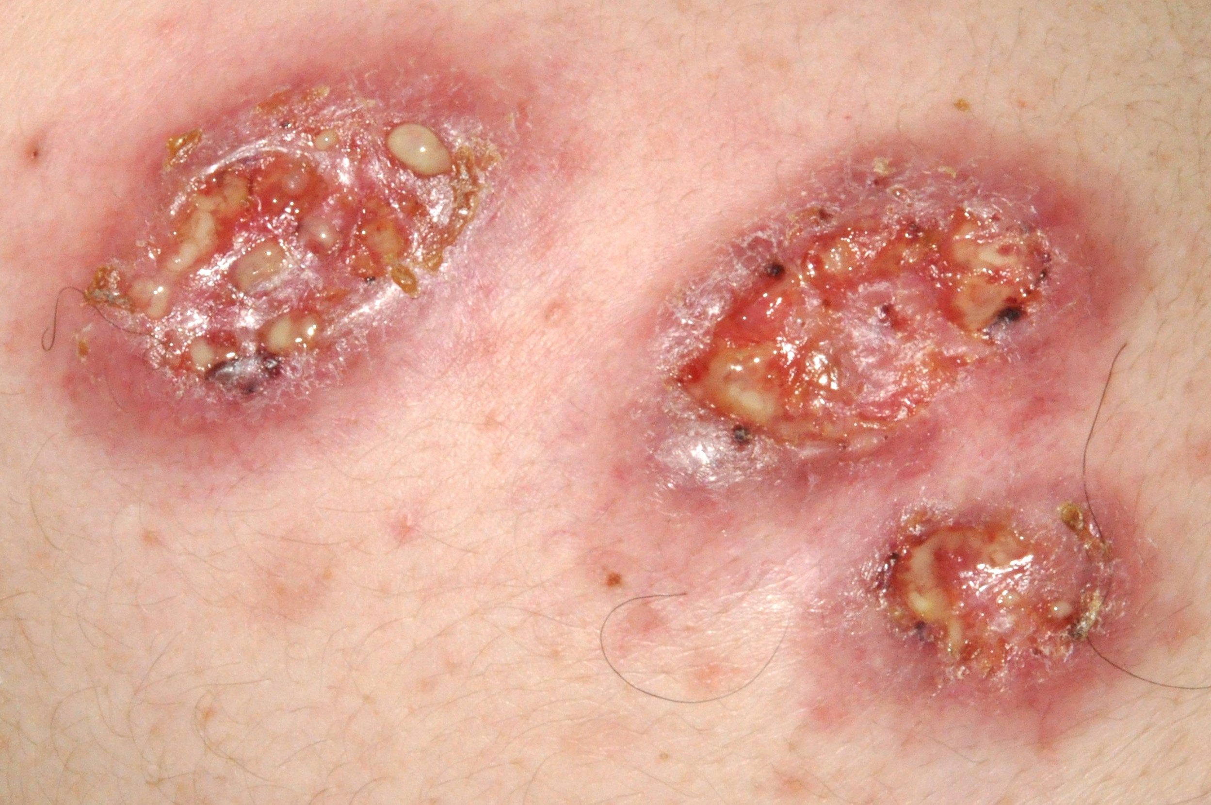 1Pioderma gangrenoso L88; lesión ulcerada, intensamente dolorosa, de bordes geográficos y socavados de color violáceo (2)