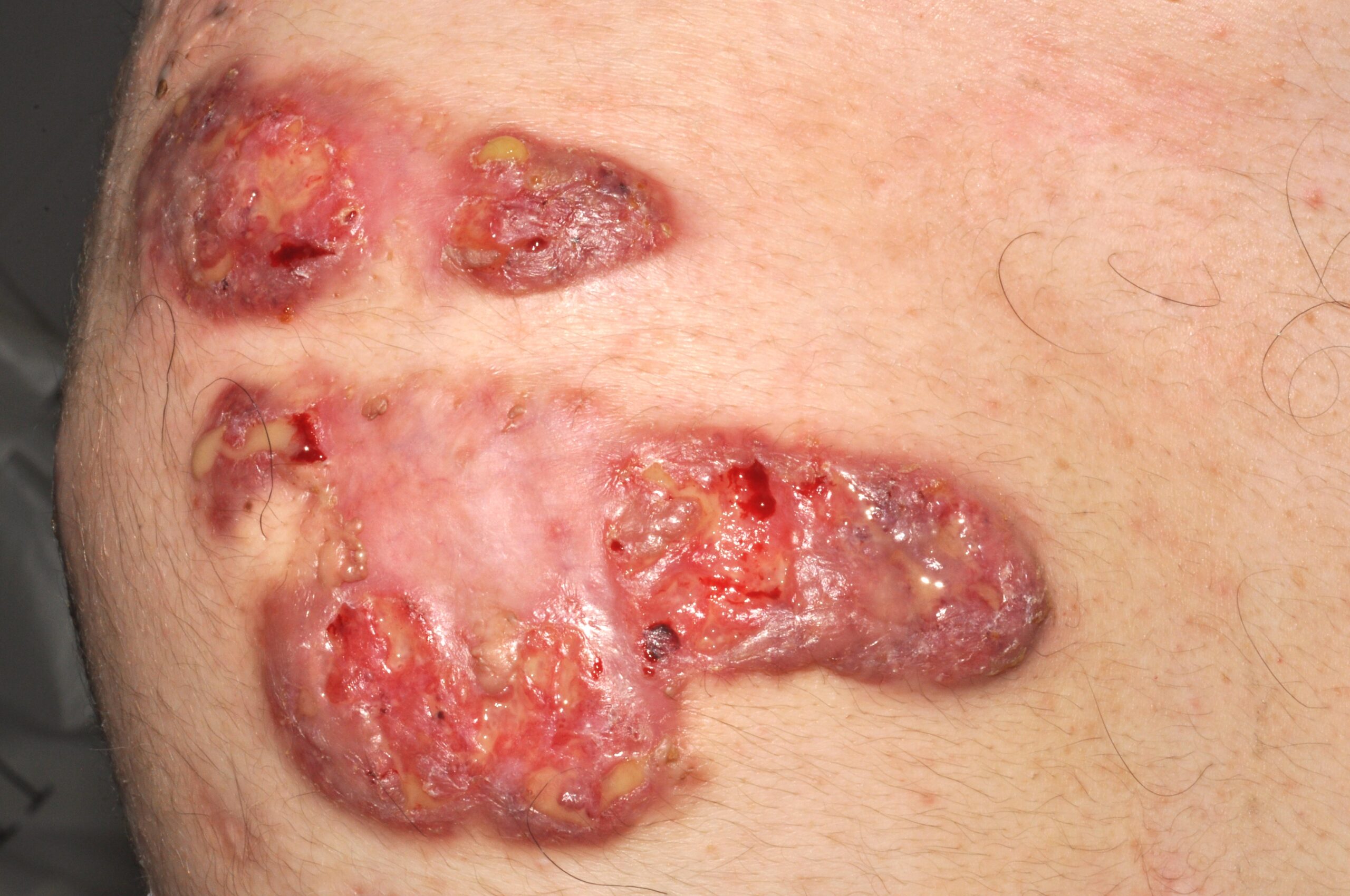 1Pioderma gangrenoso L88; lesión ulcerada, intensamente dolorosa, de bordes geográficos y socavados de color violáceo (5)