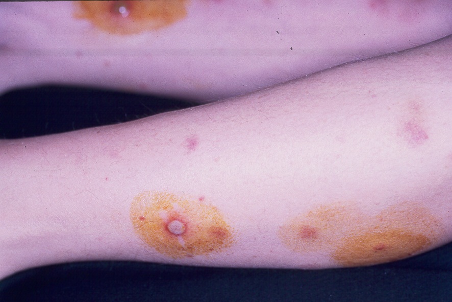 1Pioderma gangrenoso L88; lesiones pustulosas incipientes1