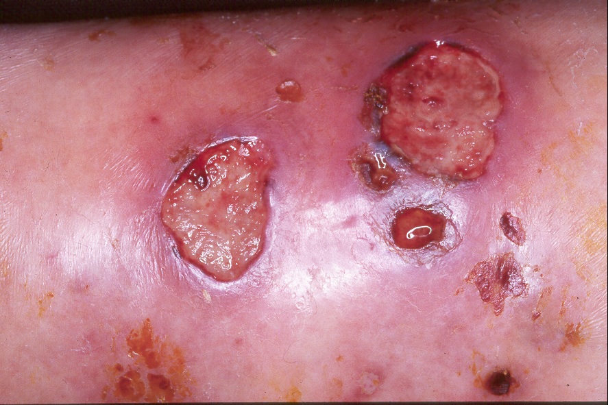 1Pioderma gangrenoso L88; lesiones ulceradas, intensamente dolorosas, de bordes geográficos y socavados de color violáceo en paciente con una colitis ulcerosa