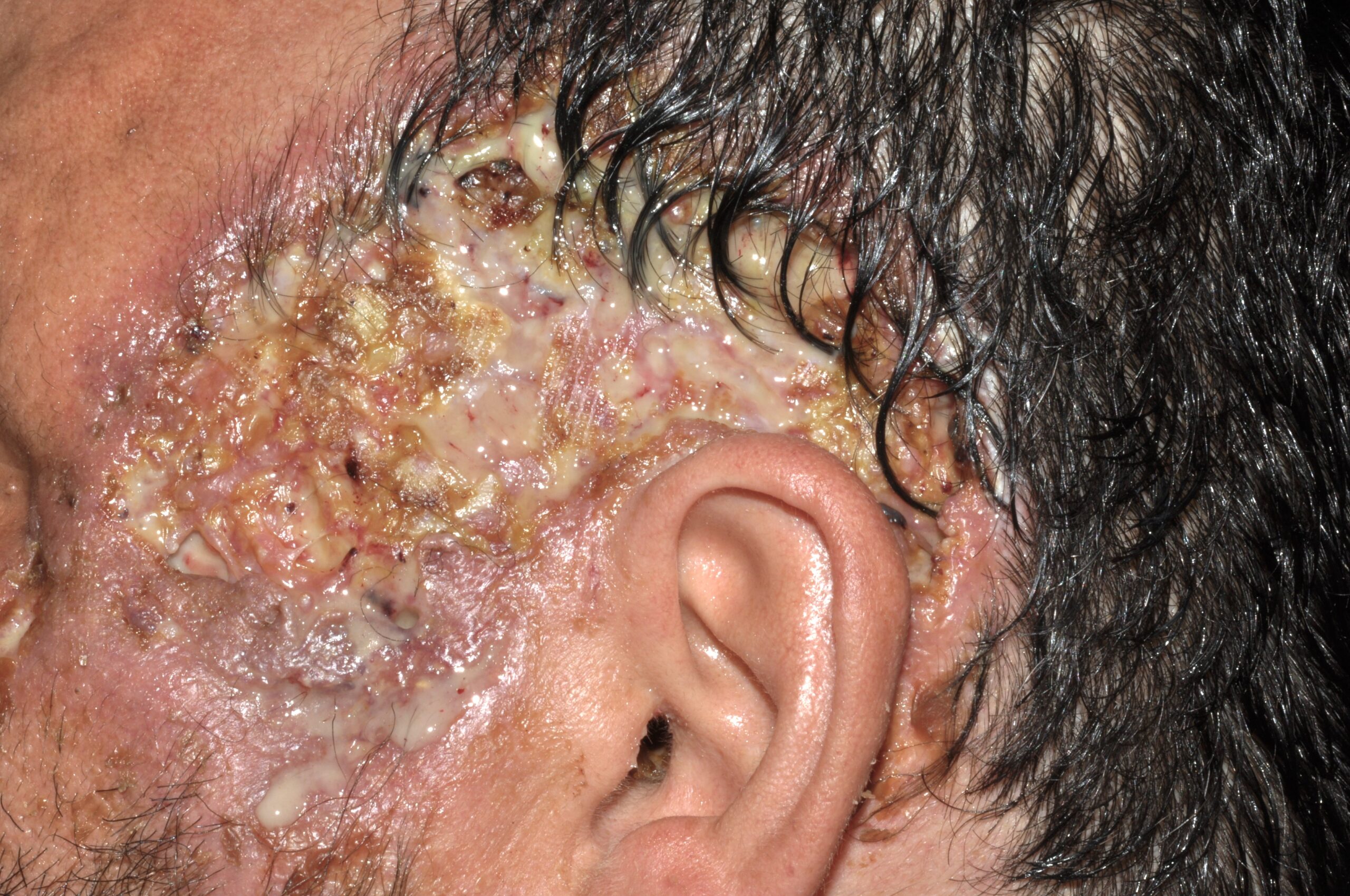 1Pioderma gangrenoso facial por cocaína levamisol L88; lesión ulcerada, intensamente dolorosa y supurativa, de bordes geográficos y socavados