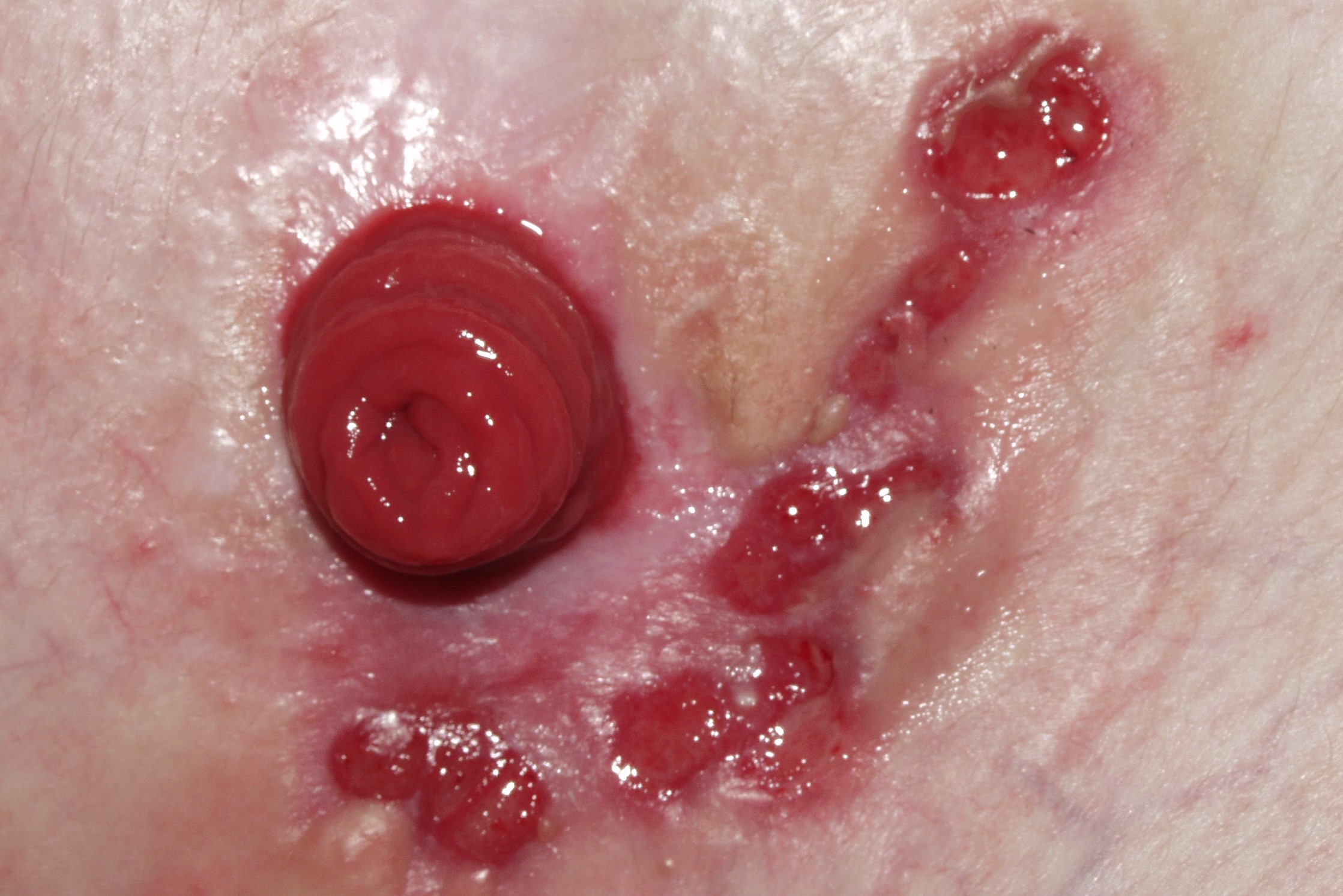 1Pioderma gangrenoso periestomal L88; lesiones ulceradas de bordes vlolaceos alrededor del orificio de la osteomía