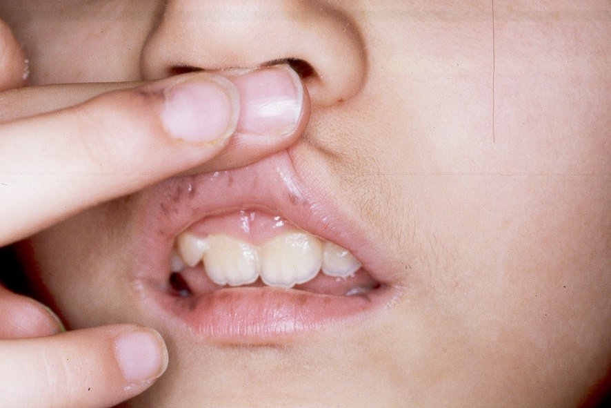 1Síndrome de Peutz-Jeghers Q85.89; máculas negro-azuladas (lentigos) en los labios1 (1)